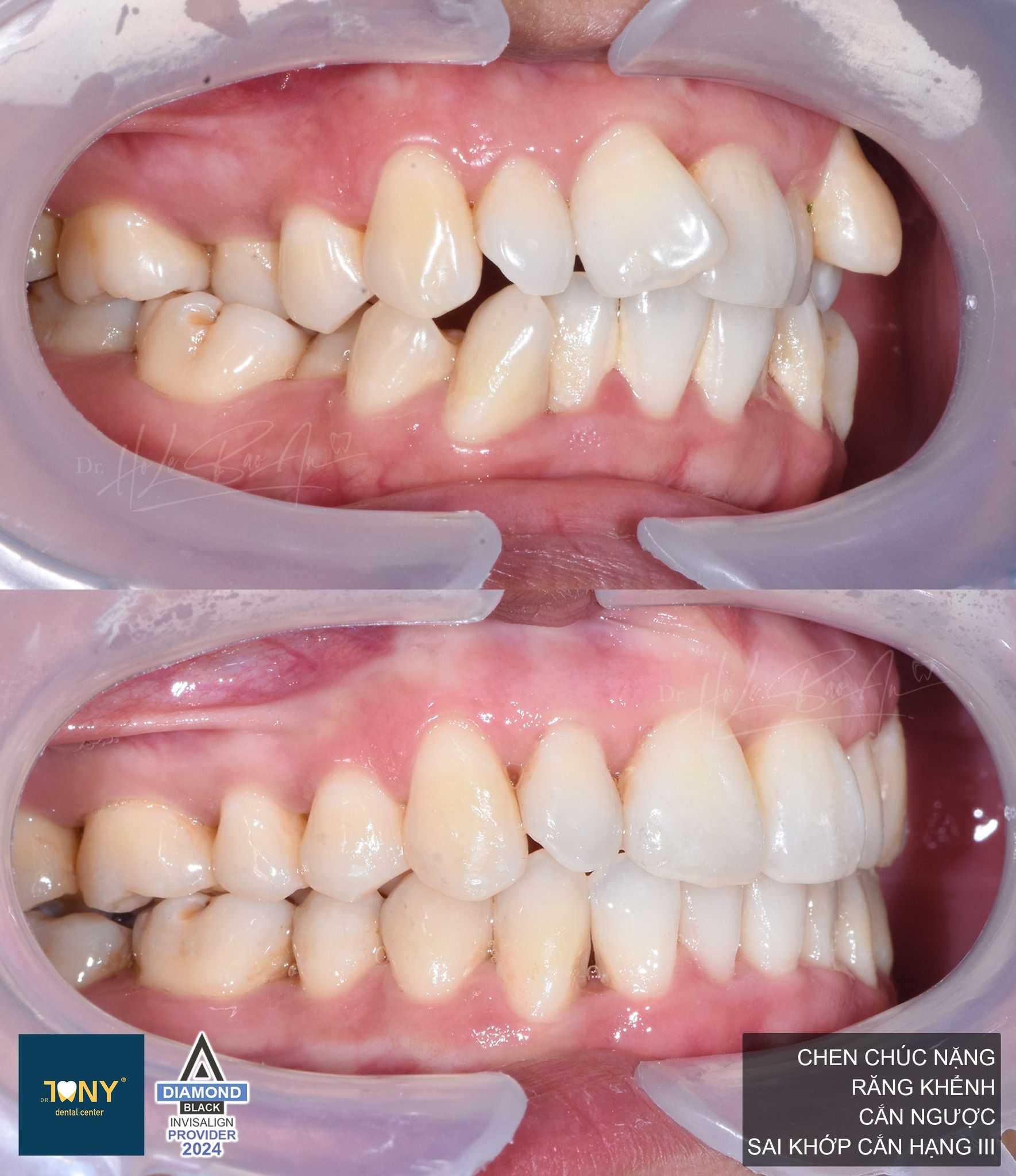 Ca chen chúc nặng, răng khểnh, cắn ngược và sai khớp cắn hạng III — khớp cắn bên trước và sau điều trị Invisalign