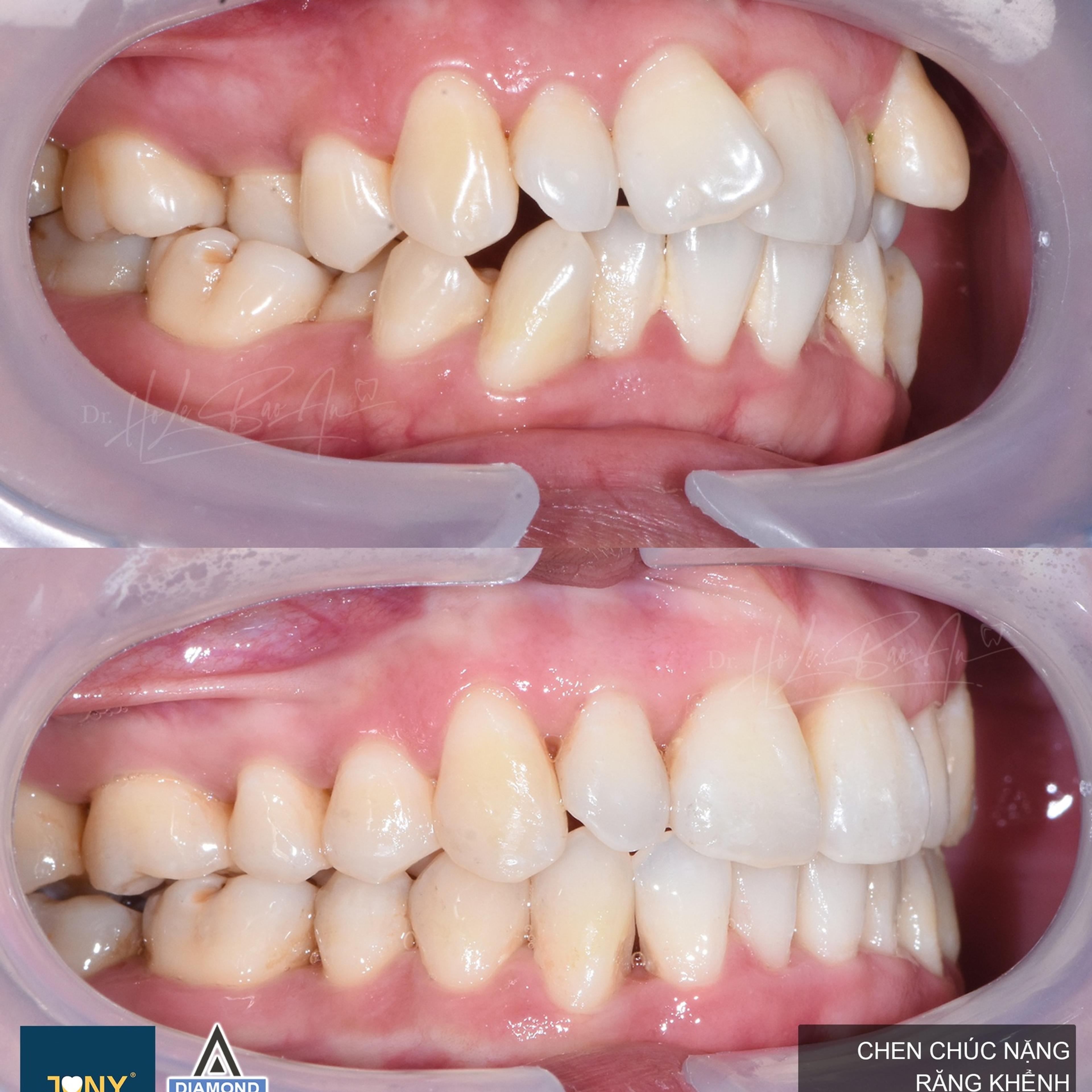 Ca chen chúc nặng, răng khểnh, cắn ngược và sai khớp cắn hạng III — khớp cắn bên trước và sau điều trị Invisalign