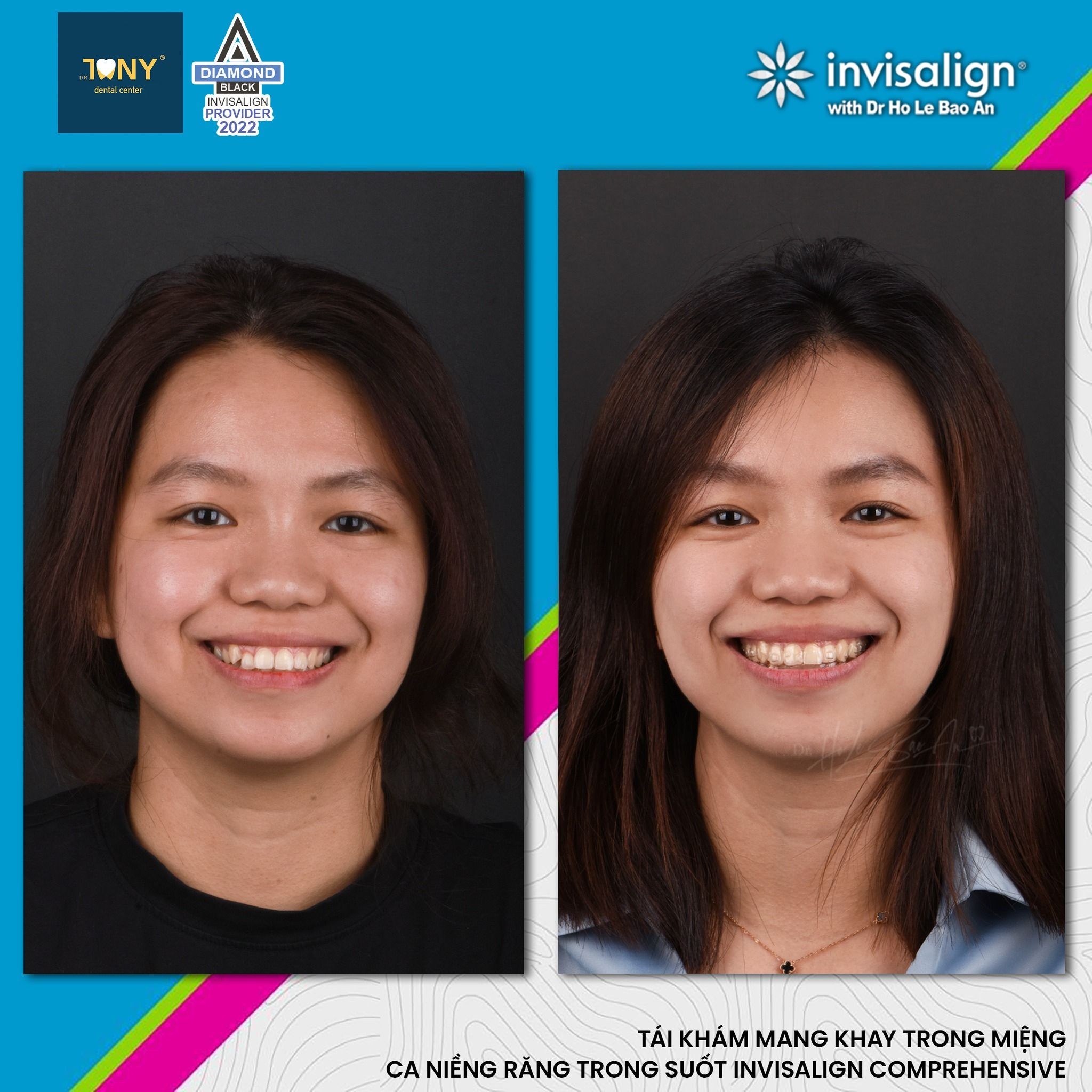 Chân dung một ca Invisalign Comprehensive, trước điều trị và khi tái khám — bệnh nhân đang mang khay trong miệng