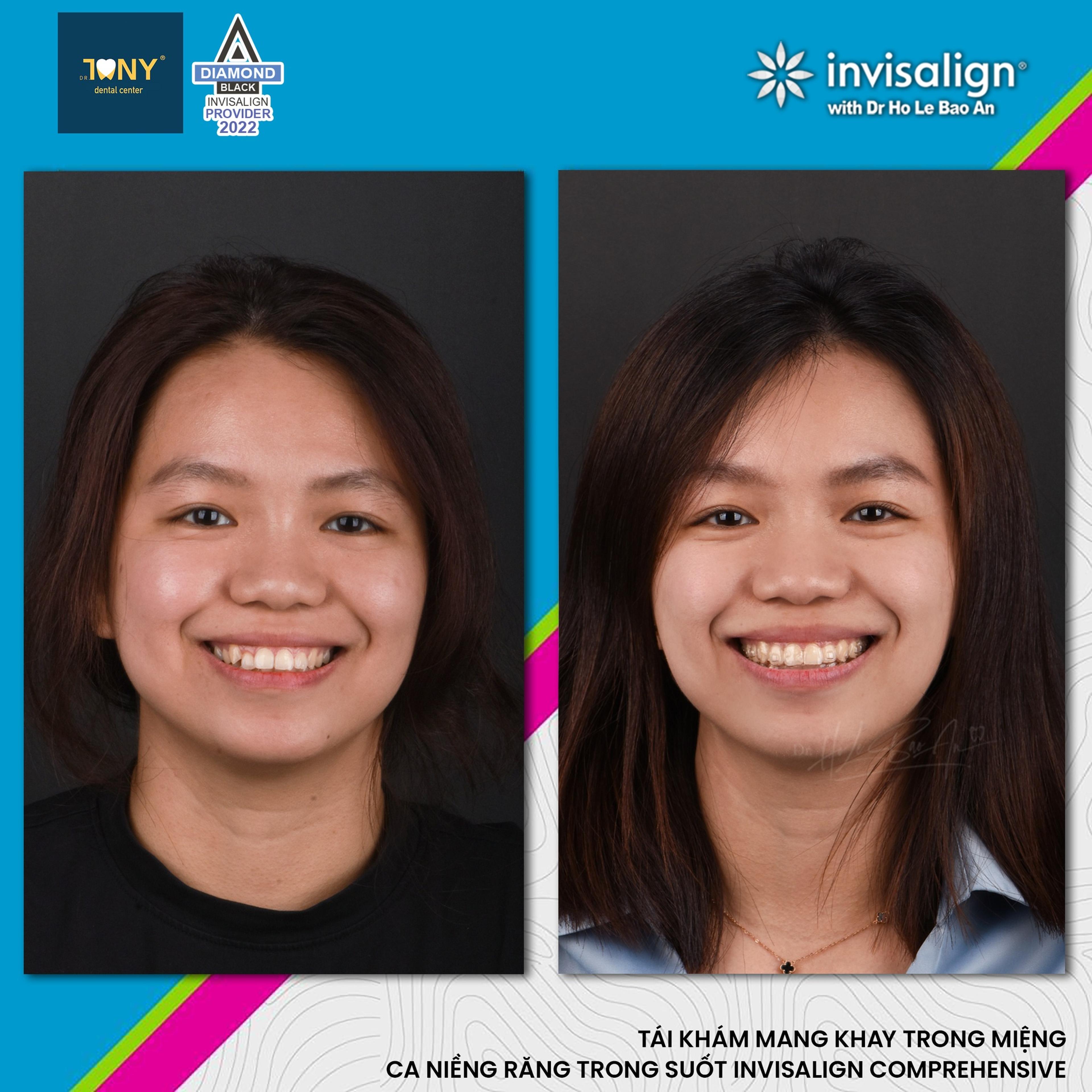Chân dung một ca Invisalign Comprehensive, trước điều trị và khi tái khám — bệnh nhân đang mang khay trong miệng