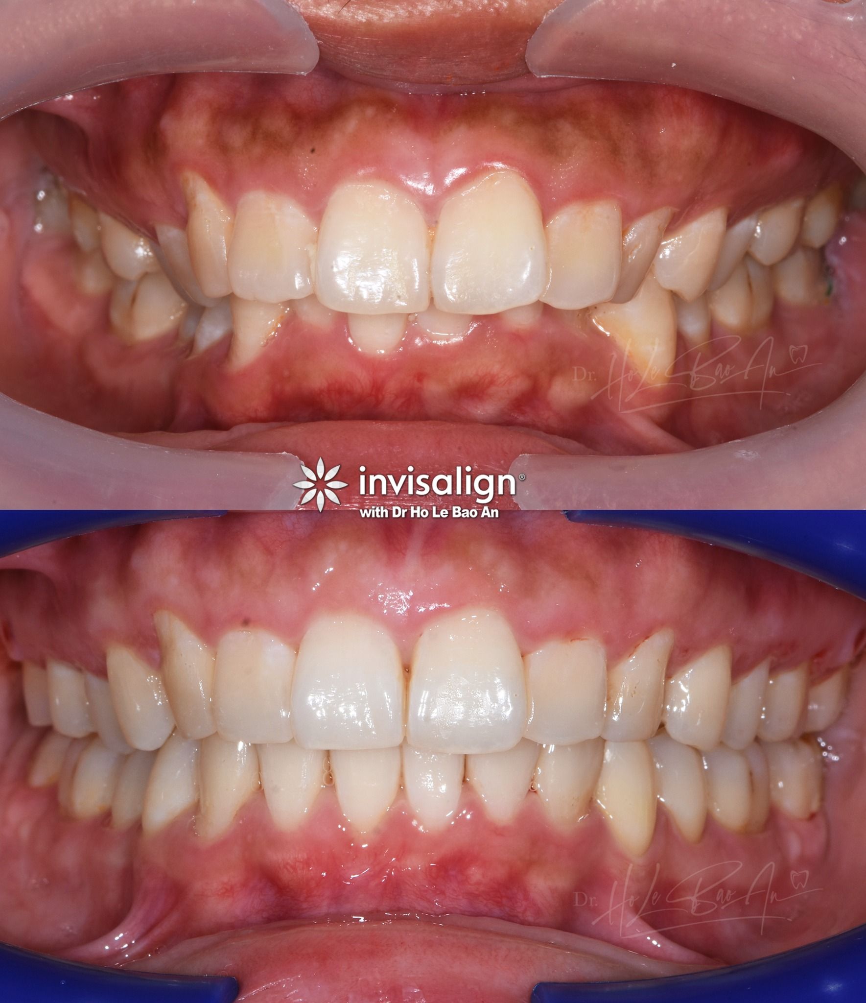 Ảnh trong miệng trước và sau niềng Invisalign: răng cửa hàm dưới chen chúc, sau điều trị hai cung răng đều