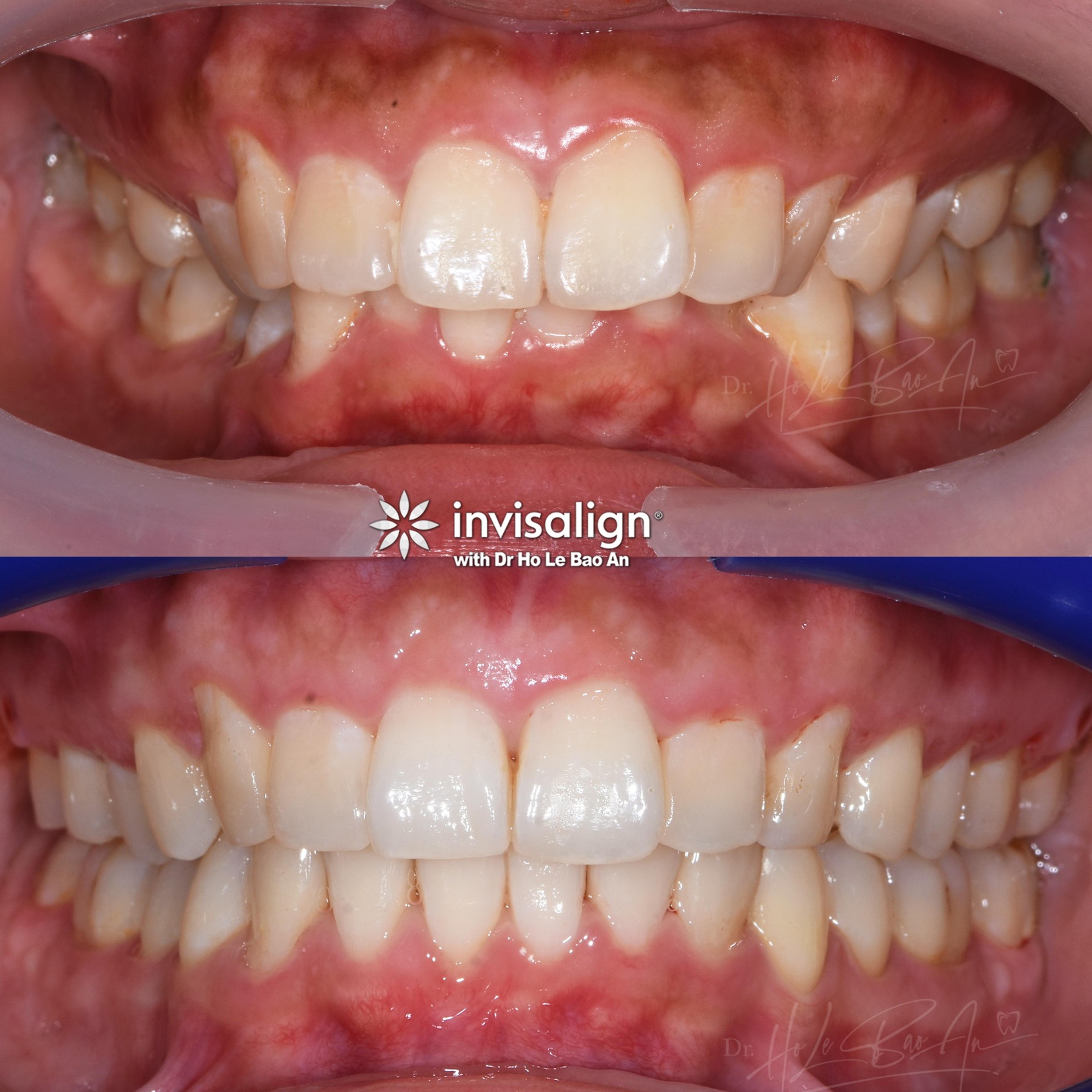 Ảnh trong miệng trước và sau niềng Invisalign: răng cửa hàm dưới chen chúc, sau điều trị hai cung răng đều