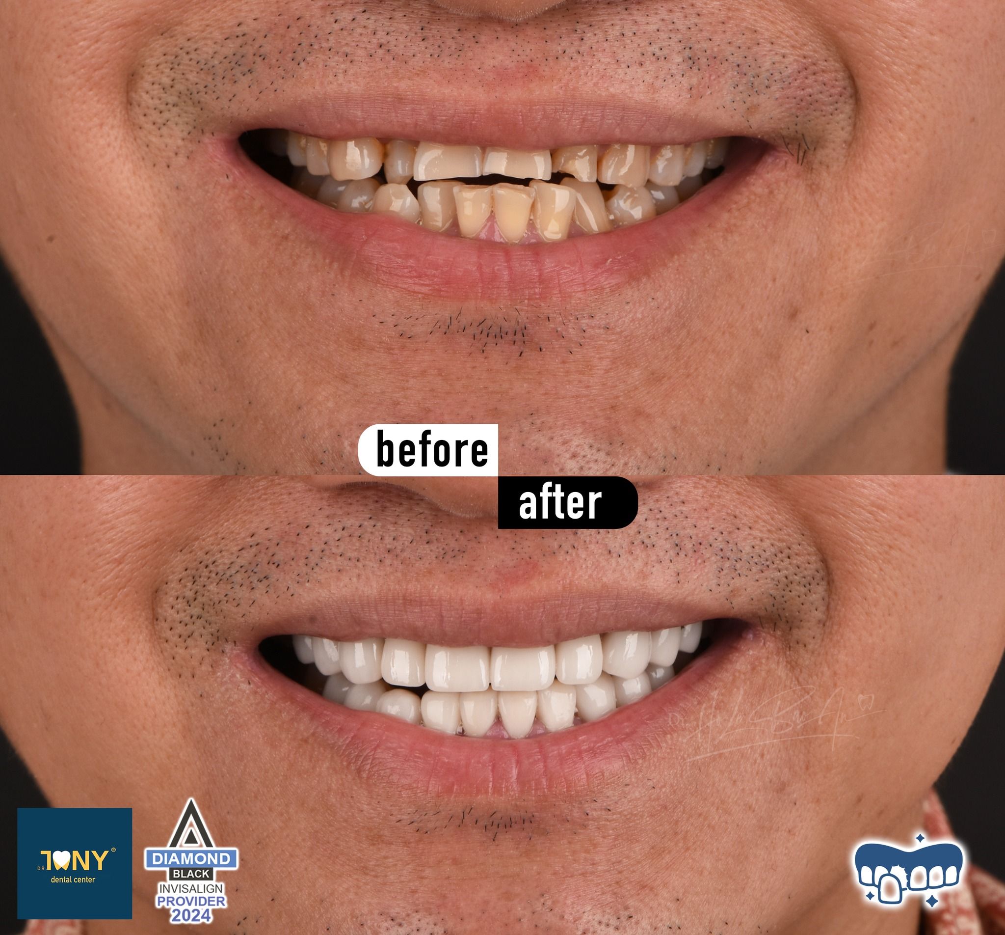 Close-up of the smile before and after veneers: yellowed teeth with uneven incisal edges, even afterwards