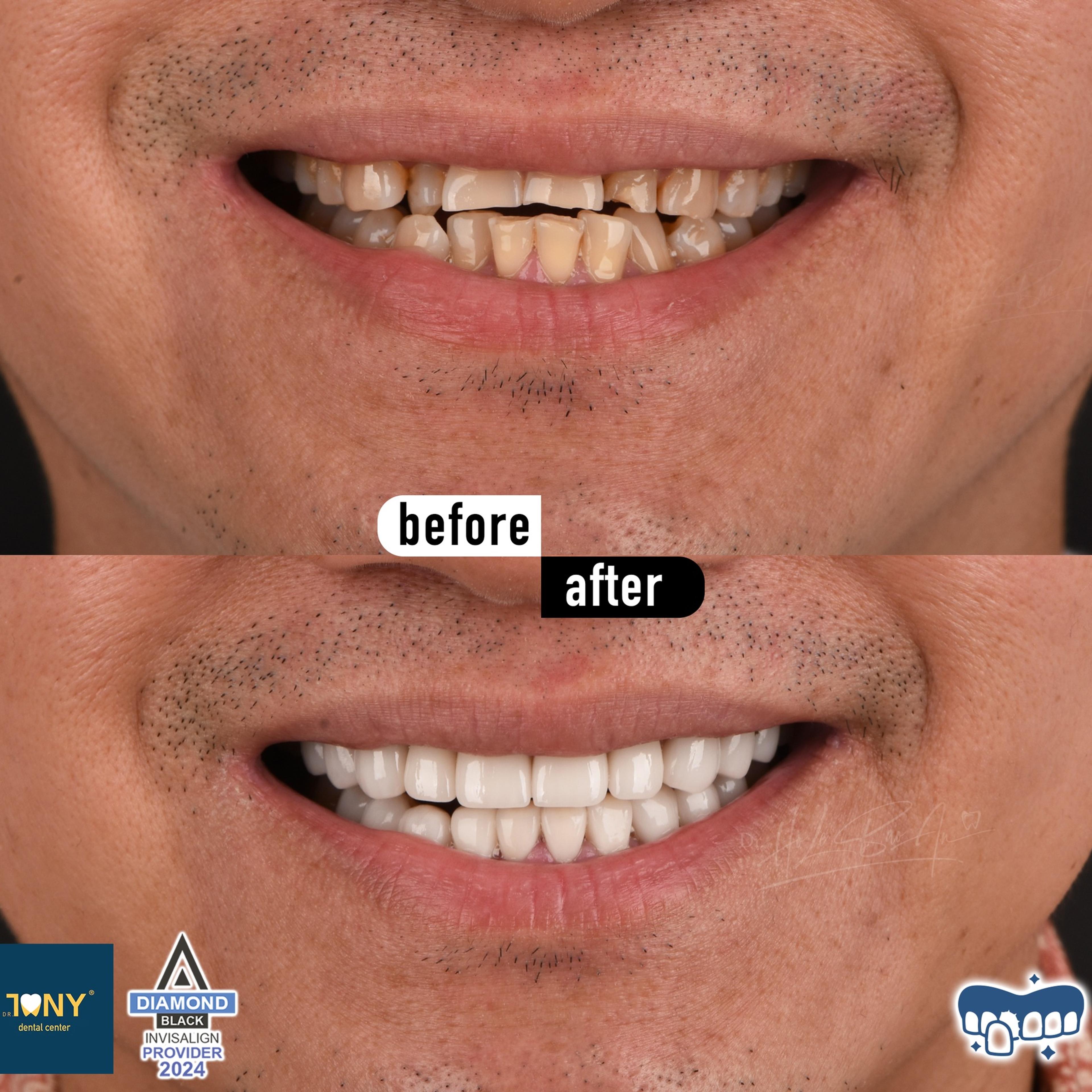 Close-up of the smile before and after veneers: yellowed teeth with uneven incisal edges, even afterwards