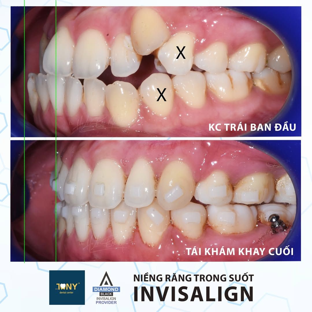 Khớp cắn nhìn từ bên, ban đầu và ở lần tái khám khay cuối: hai răng đánh dấu X là răng nhổ theo phác đồ