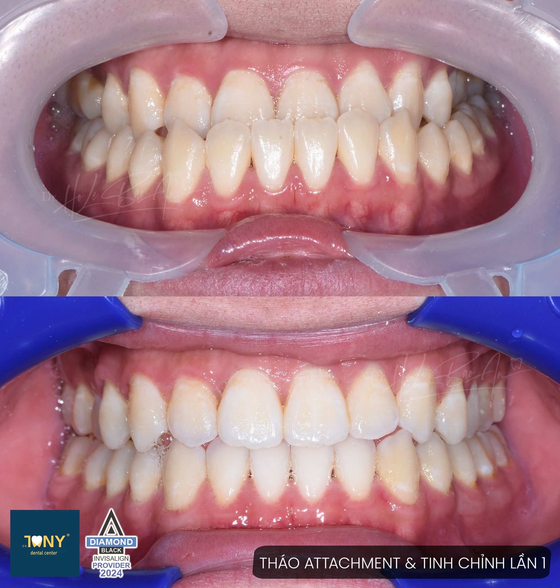 Ca Invisalign ở bước tháo attachment và tinh chỉnh lần 1 — ảnh trong miệng trước và sau khi gỡ attachment