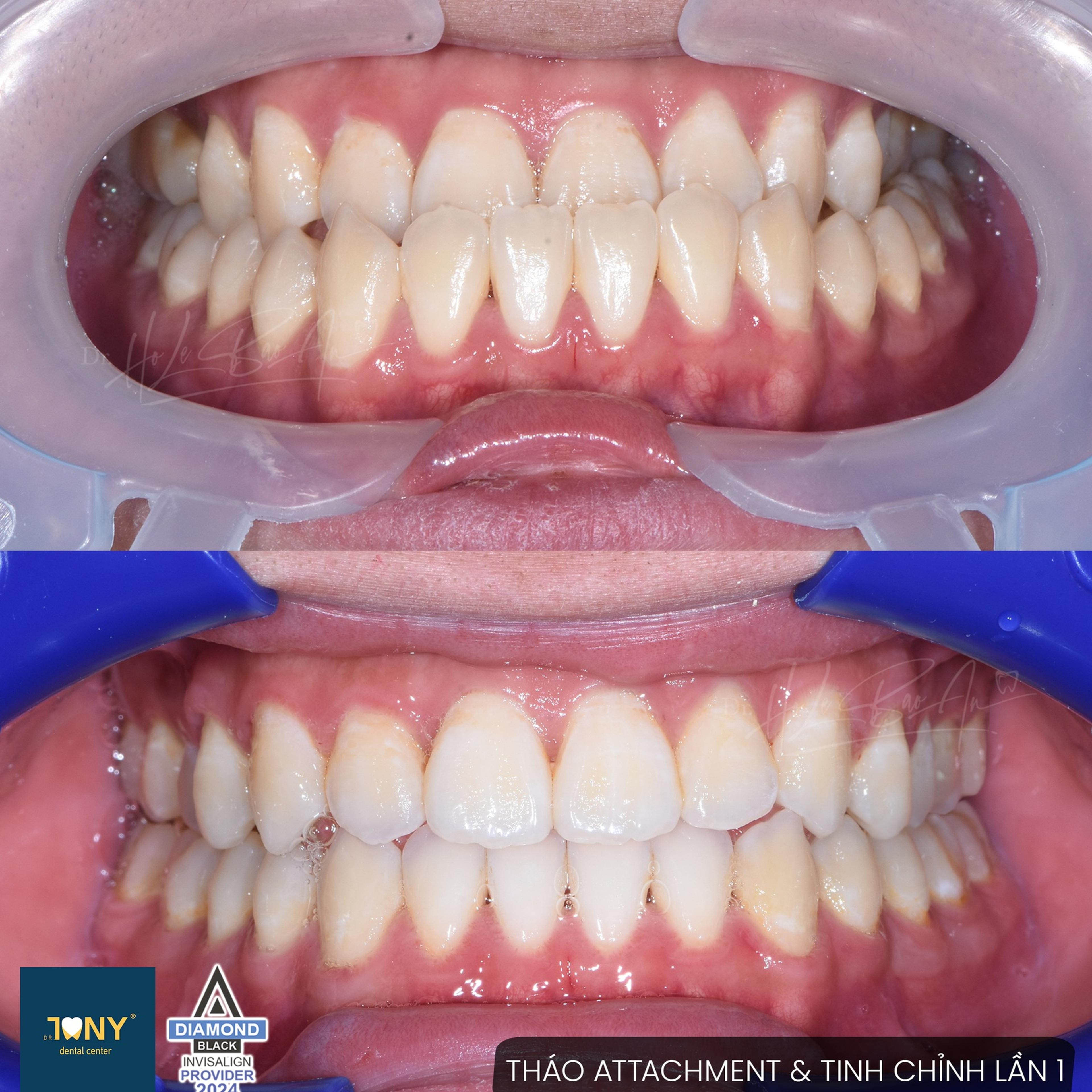 Ca Invisalign ở bước tháo attachment và tinh chỉnh lần 1 — ảnh trong miệng trước và sau khi gỡ attachment