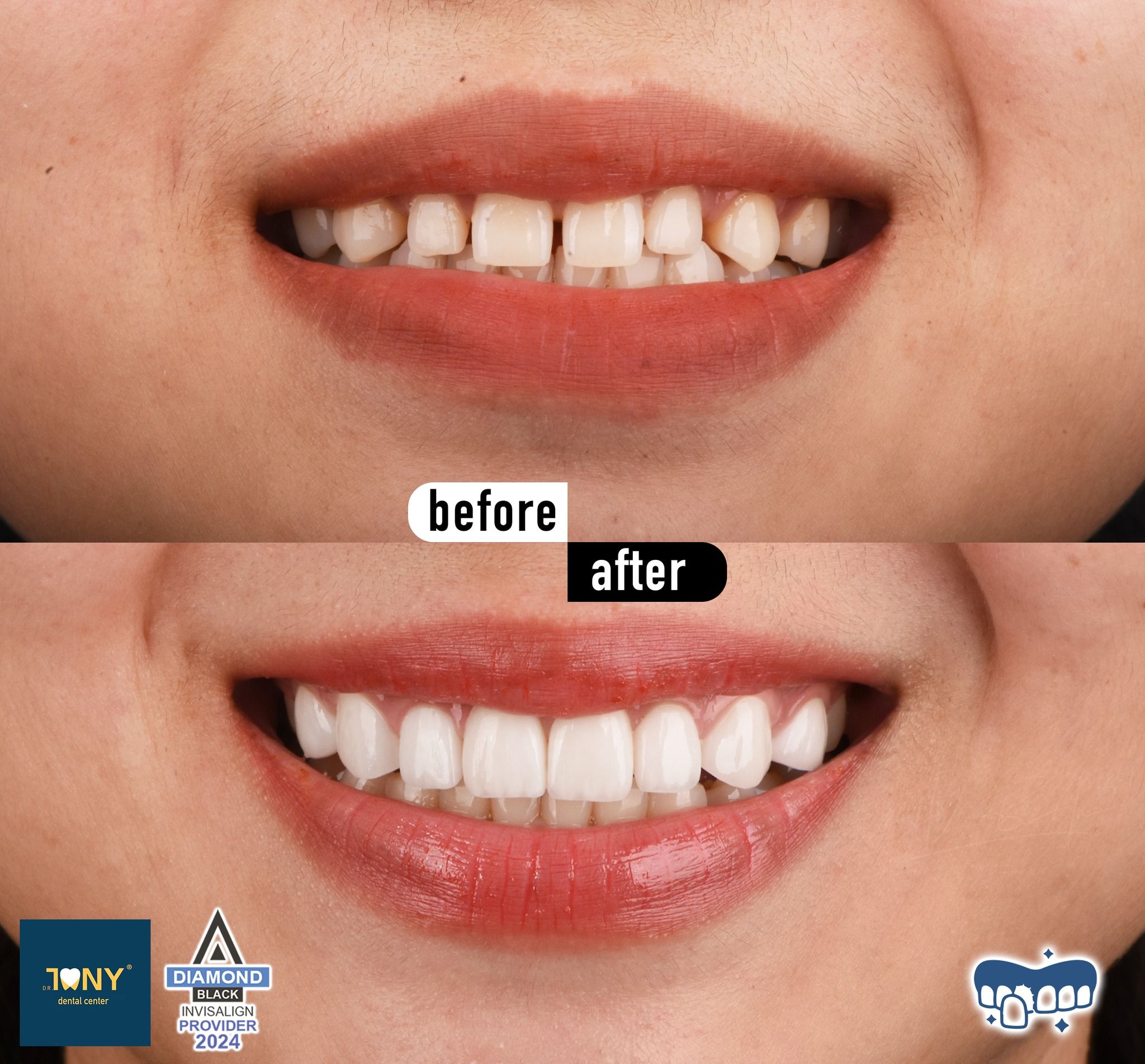 Close-up smile before and after veneers: spaced, narrow teeth; gaps closed and proportions evened afterwards