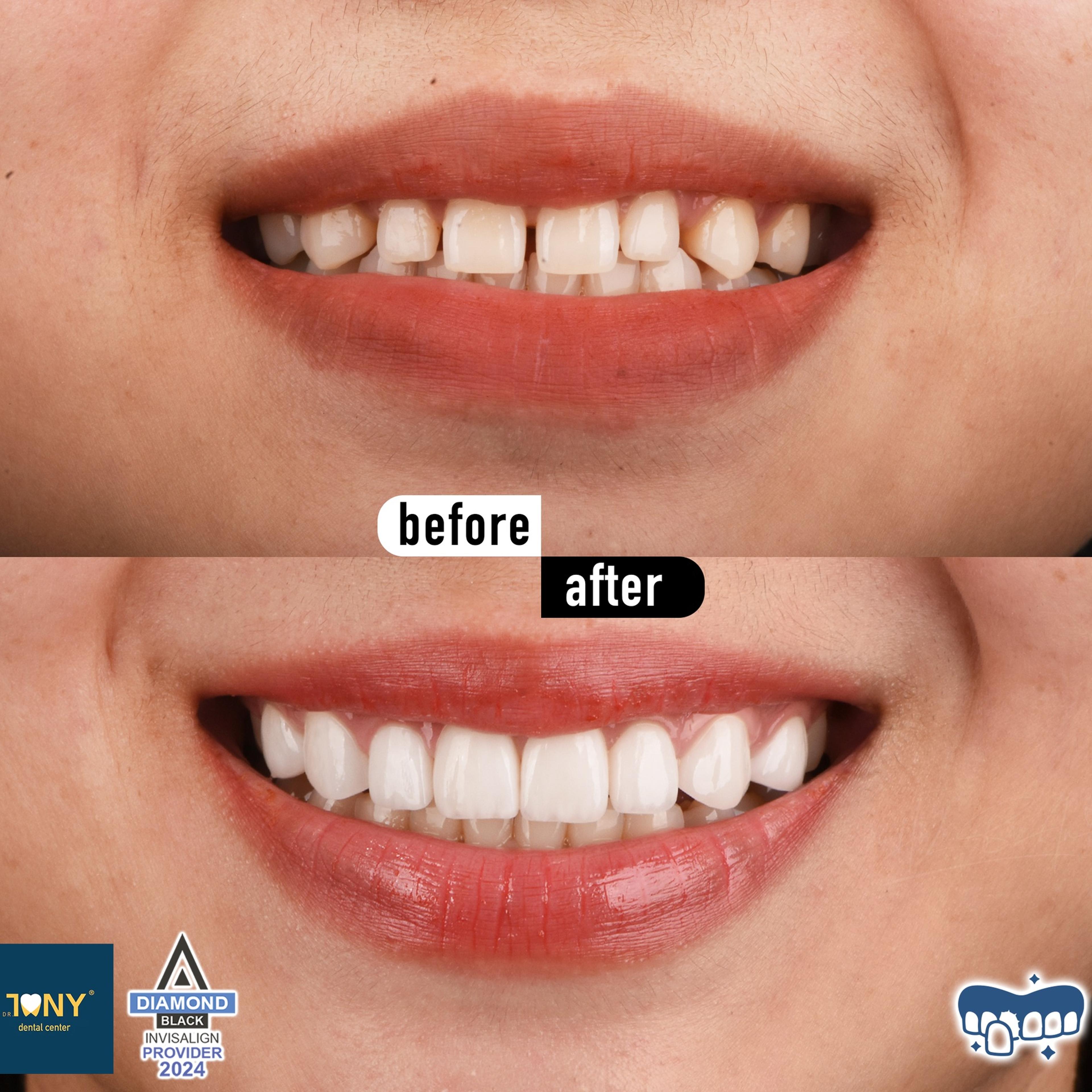 Close-up smile before and after veneers: spaced, narrow teeth; gaps closed and proportions evened afterwards