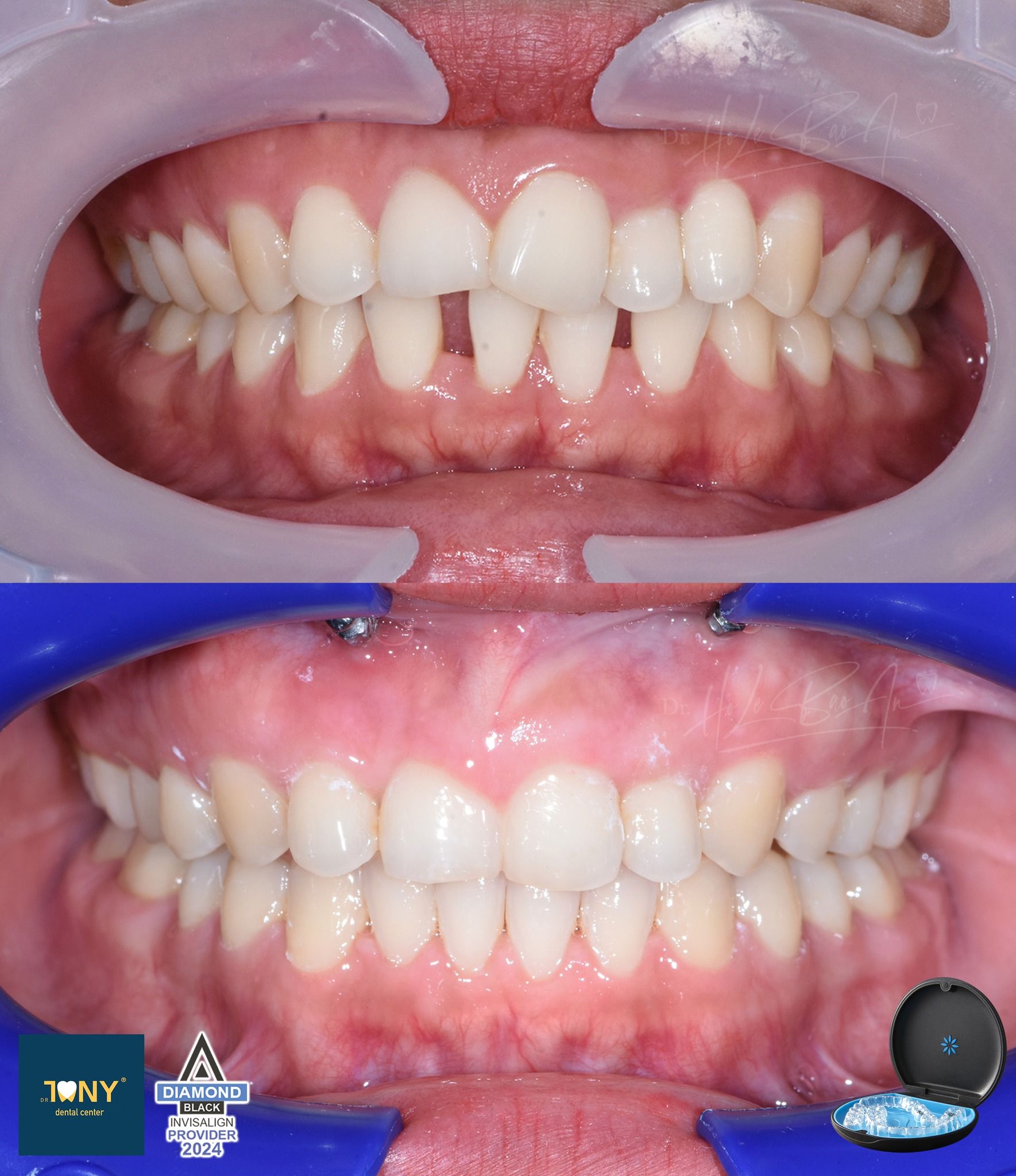 Ảnh trong miệng trước và sau điều trị Invisalign: răng thưa và khớp cắn lệch, có dùng minivis hỗ trợ neo chặn