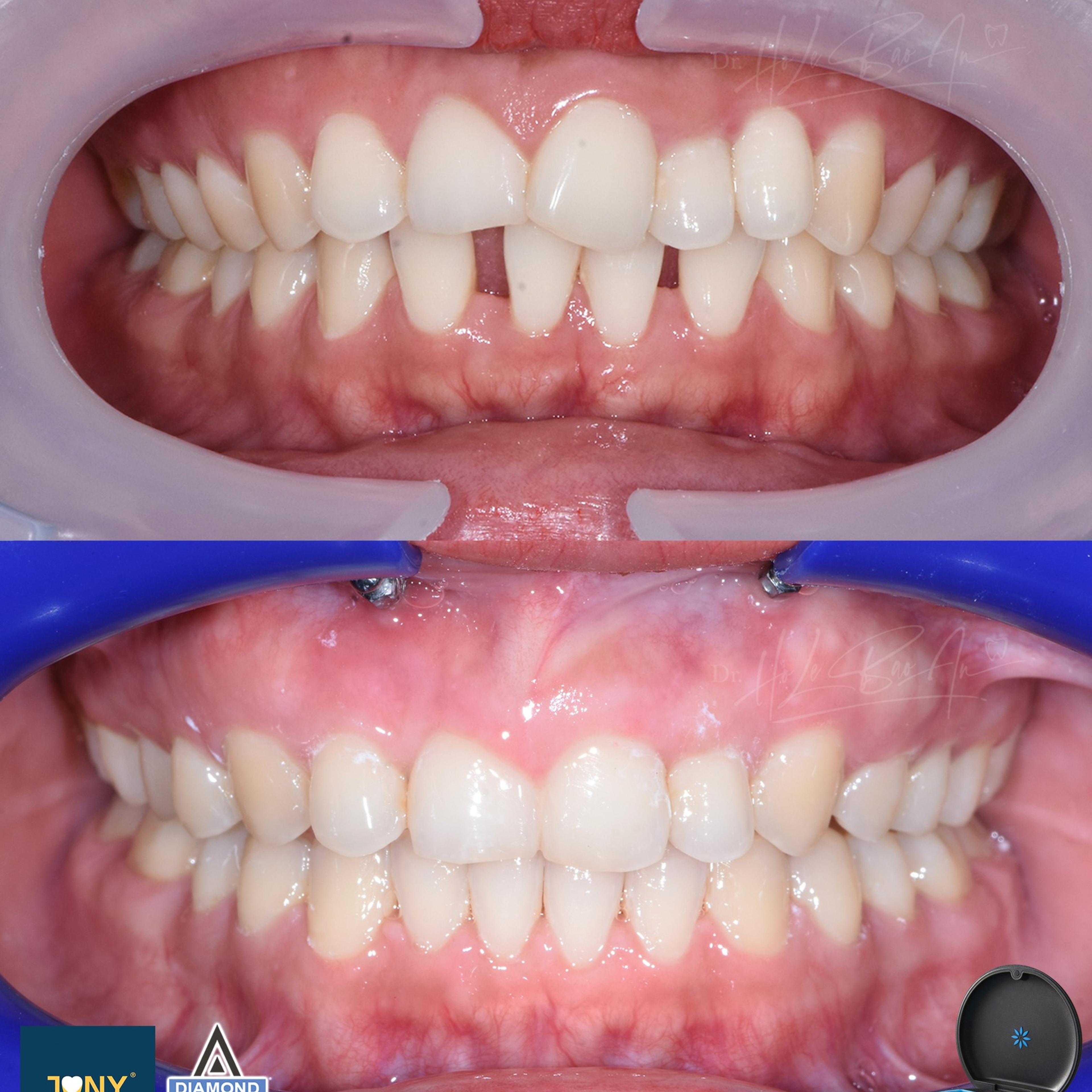 Ảnh trong miệng trước và sau điều trị Invisalign: răng thưa và khớp cắn lệch, có dùng minivis hỗ trợ neo chặn