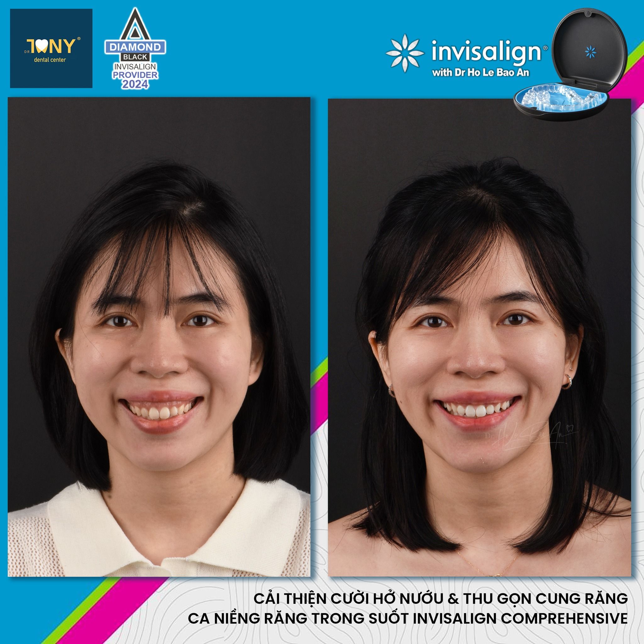 Chân dung trước và sau một ca Invisalign Comprehensive: cải thiện cười hở nướu và thu gọn cung răng