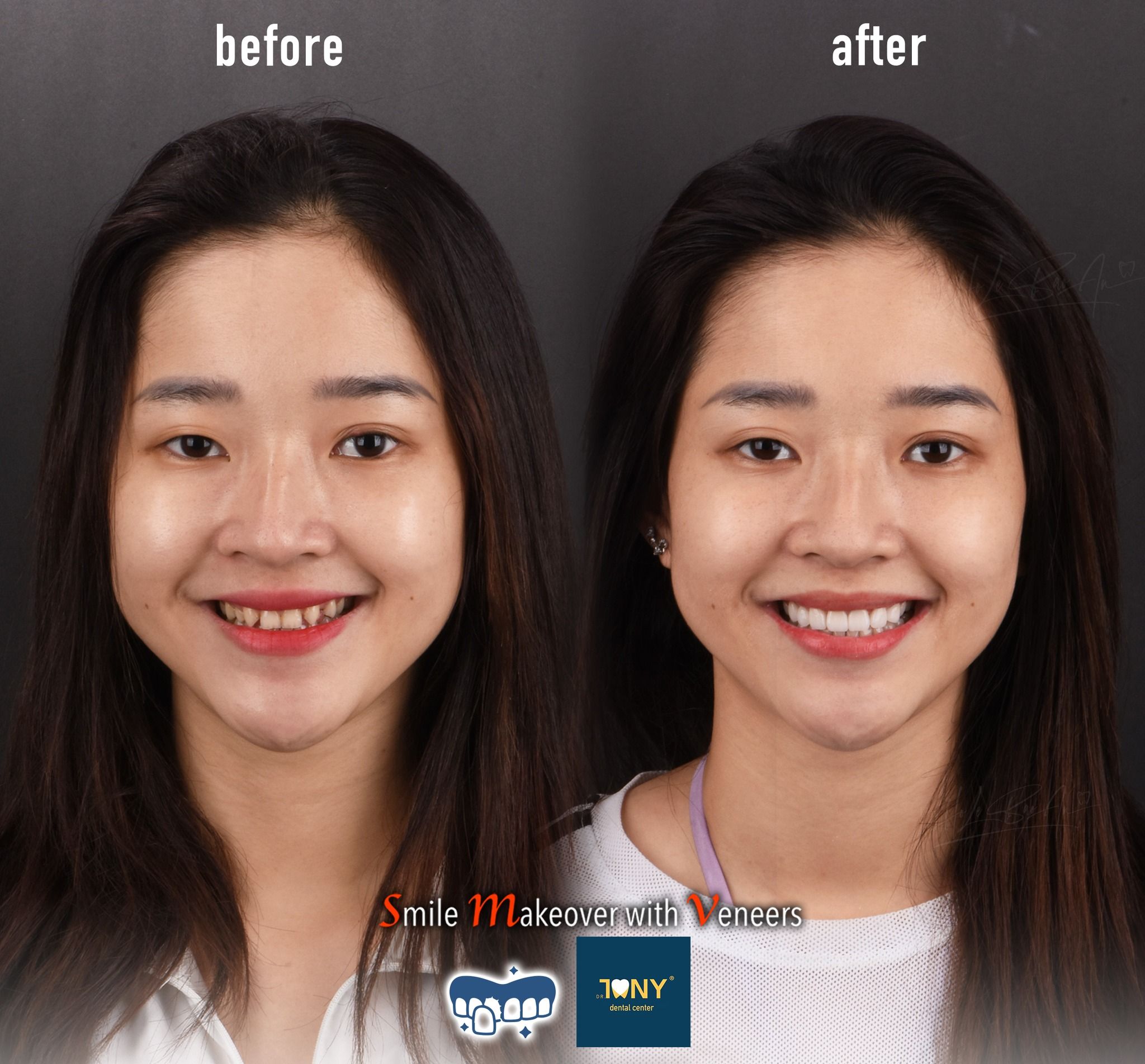 Full-face smile before and after porcelain veneers: crowded, protruding incisors, even and bright afterwards