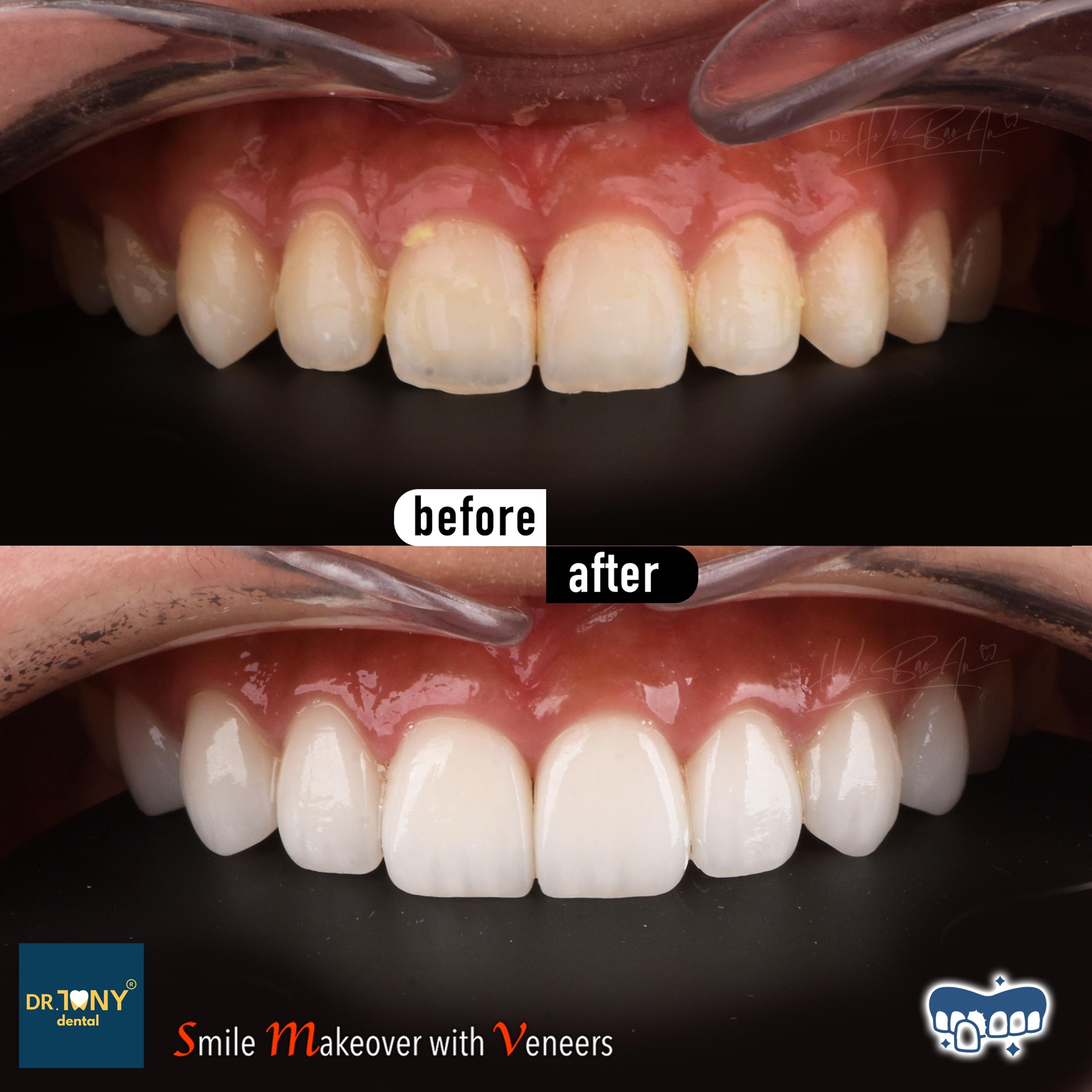 Close-up of the upper arch before and after veneers: opaque white spots and discolouration, uniform afterwards