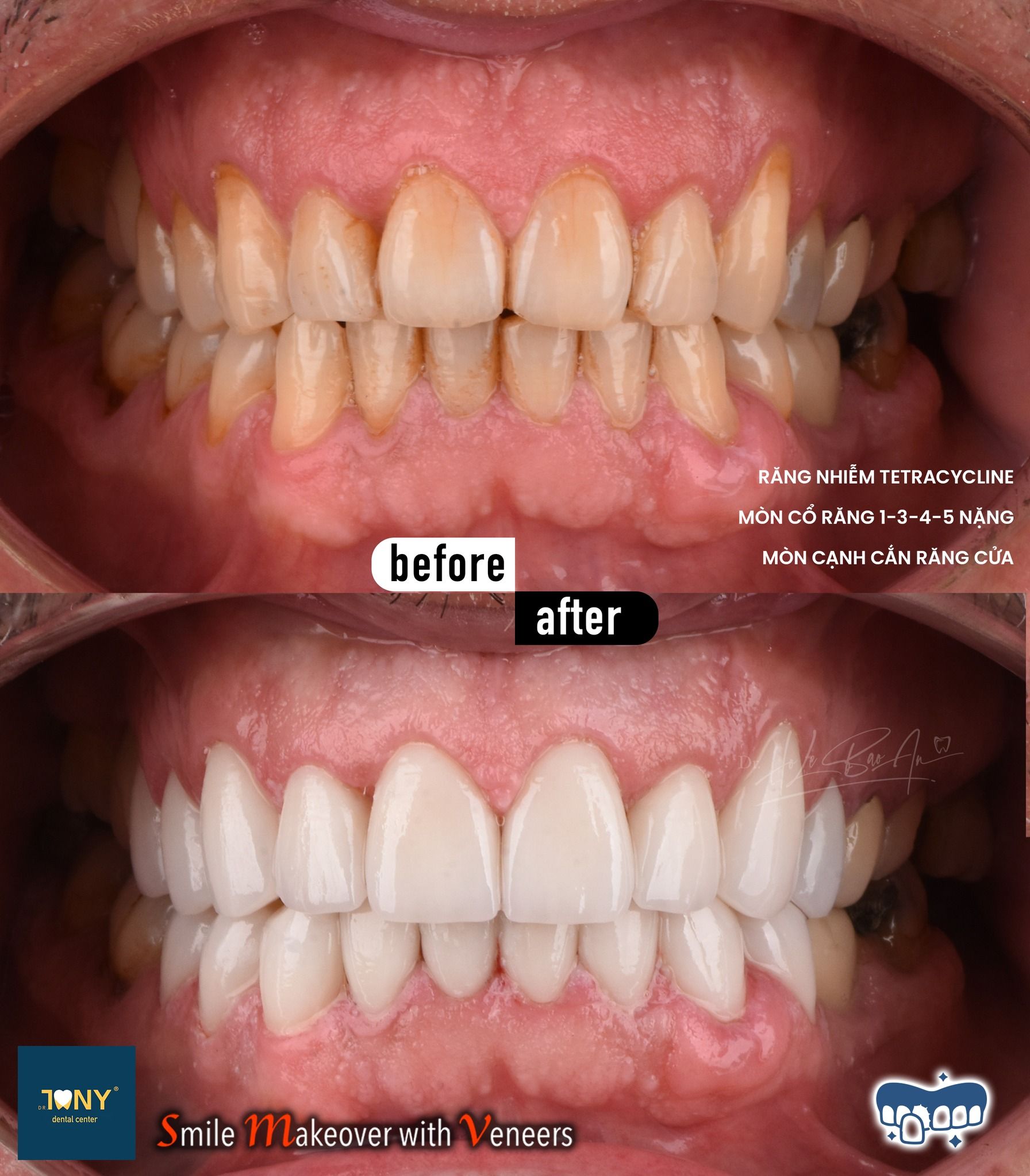 Intraoral views before and after veneers; the photo notes tetracycline staining, severe cervical wear and worn edges