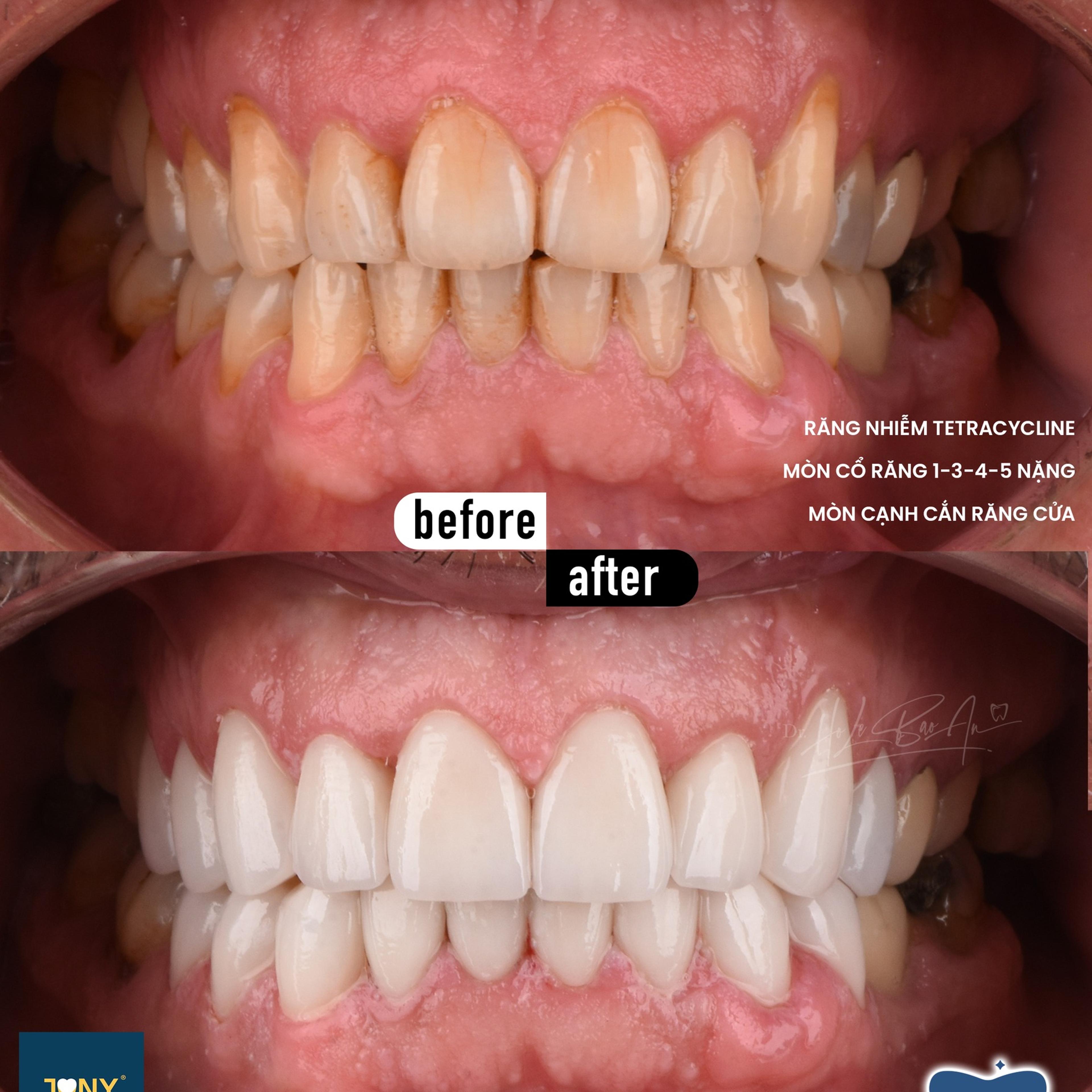 Intraoral views before and after veneers; the photo notes tetracycline staining, severe cervical wear and worn edges