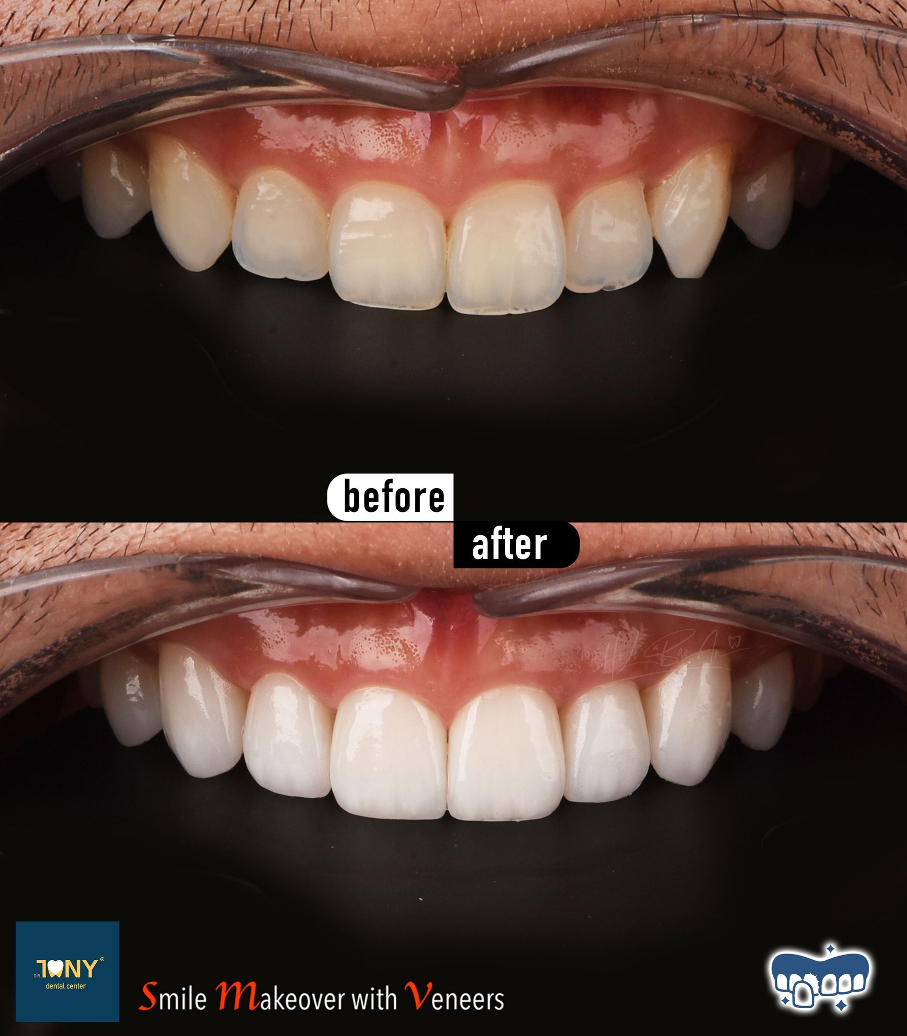 Close-up of the upper arch before and after veneers: yellowed teeth with uneven edges, matched afterwards