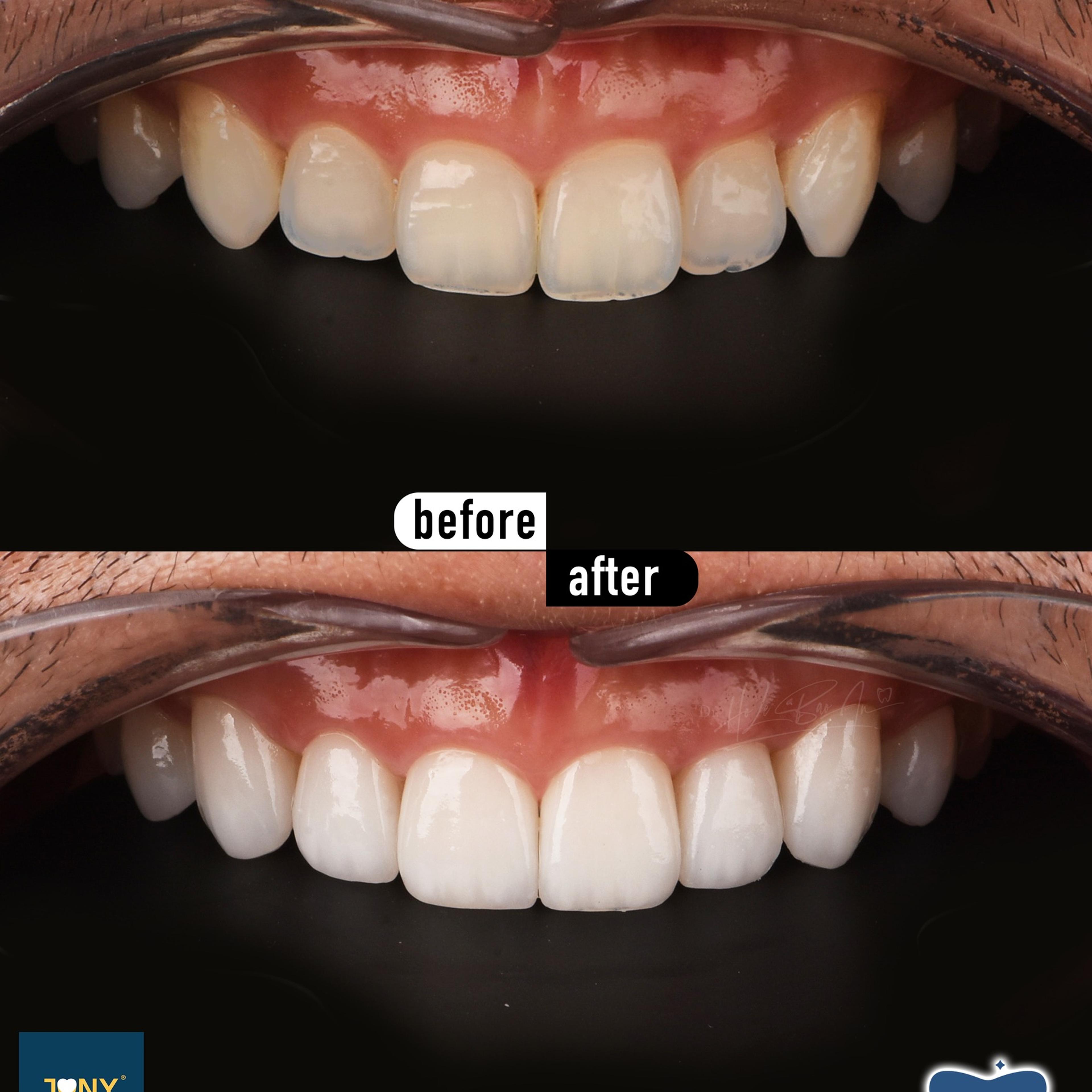 Close-up of the upper arch before and after veneers: yellowed teeth with uneven edges, matched afterwards