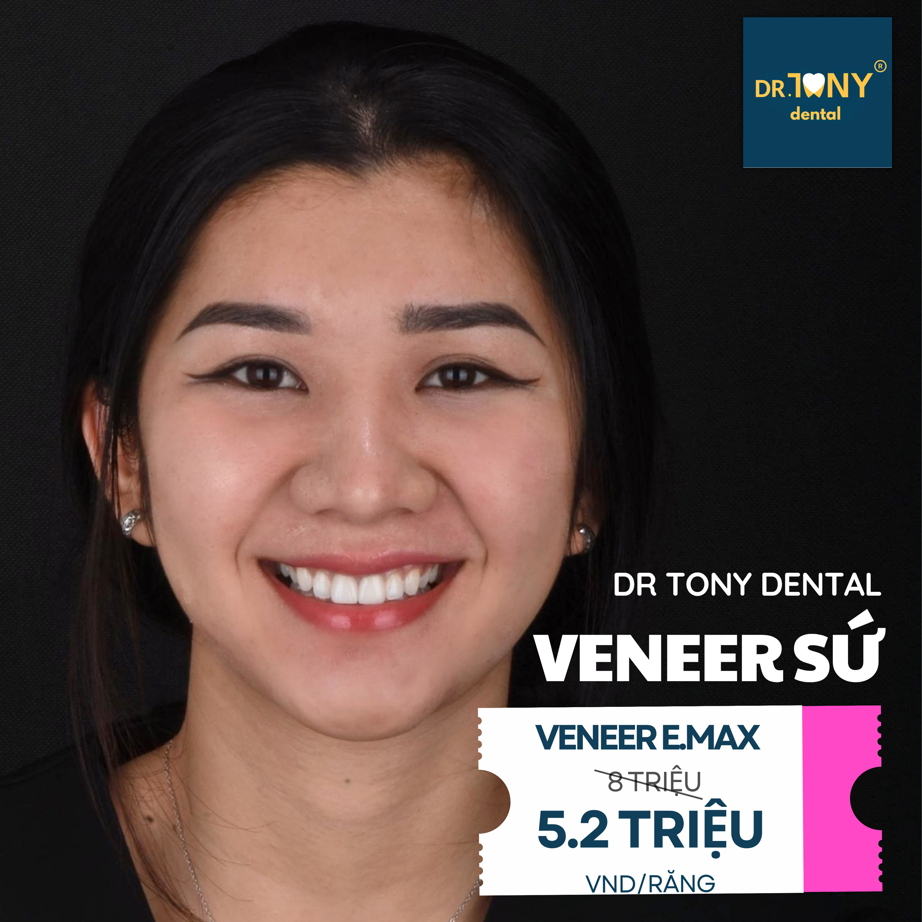 Veneer sứ E.max tại Dr Tony Dental: giá ưu đãi 5,2 triệu VND/răng, giá gốc 8 triệu.