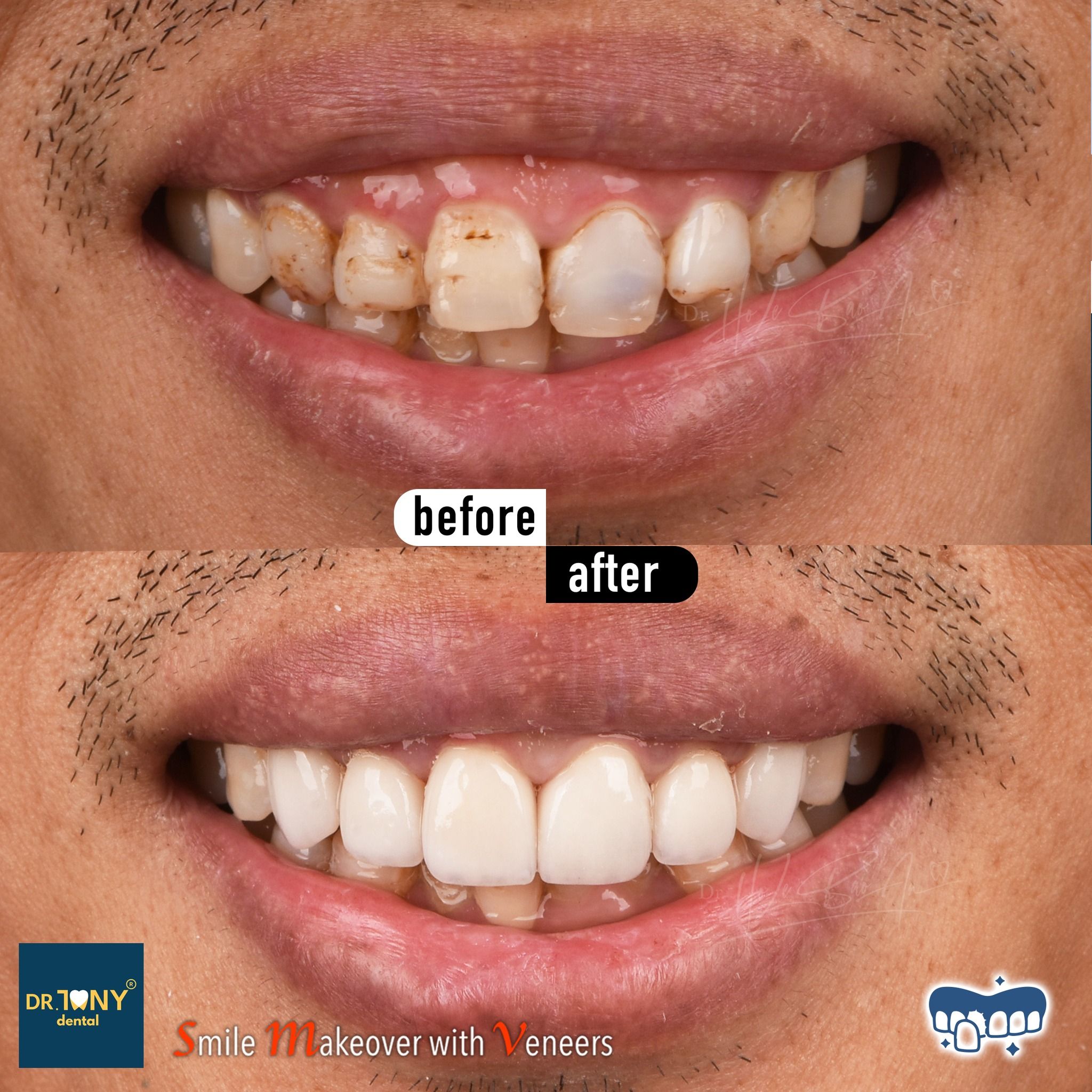 Close-up smile before and after veneers: patchy discolouration and irregular tooth shape, evened out afterwards