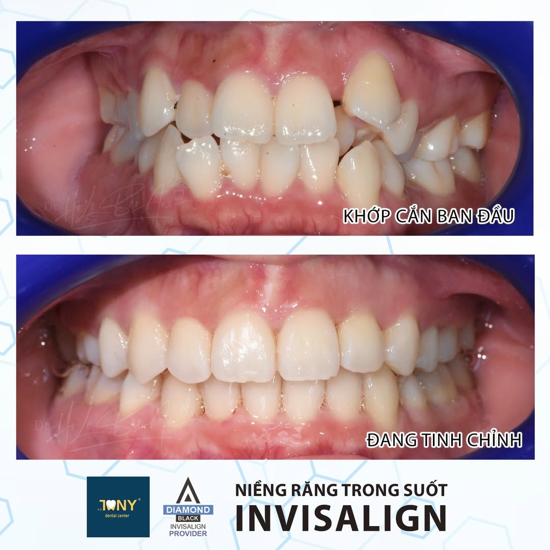 Khớp cắn ban đầu và giai đoạn đang tinh chỉnh của một ca Invisalign: răng chen chúc nặng cả hai hàm
