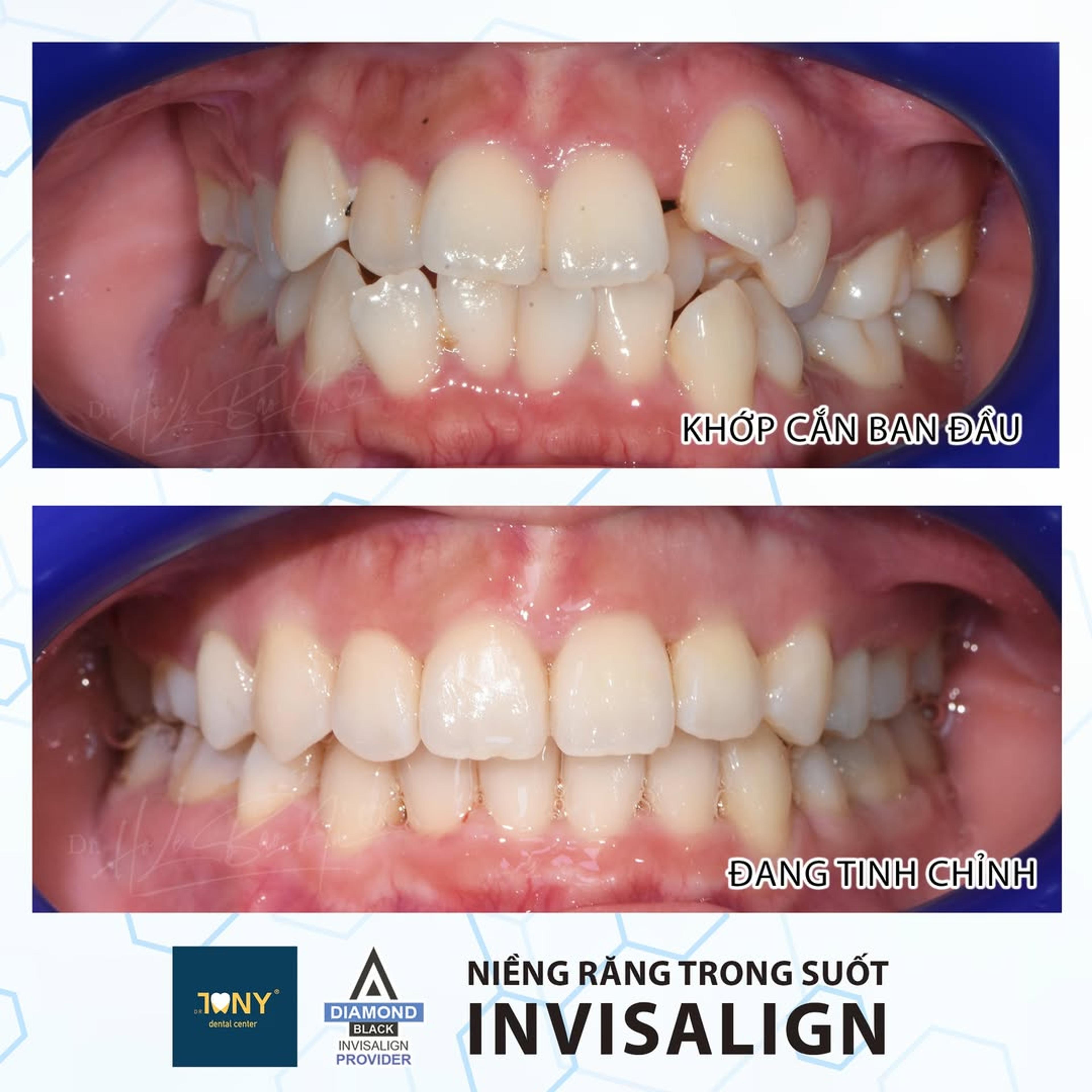 Khớp cắn ban đầu và giai đoạn đang tinh chỉnh của một ca Invisalign: răng chen chúc nặng cả hai hàm