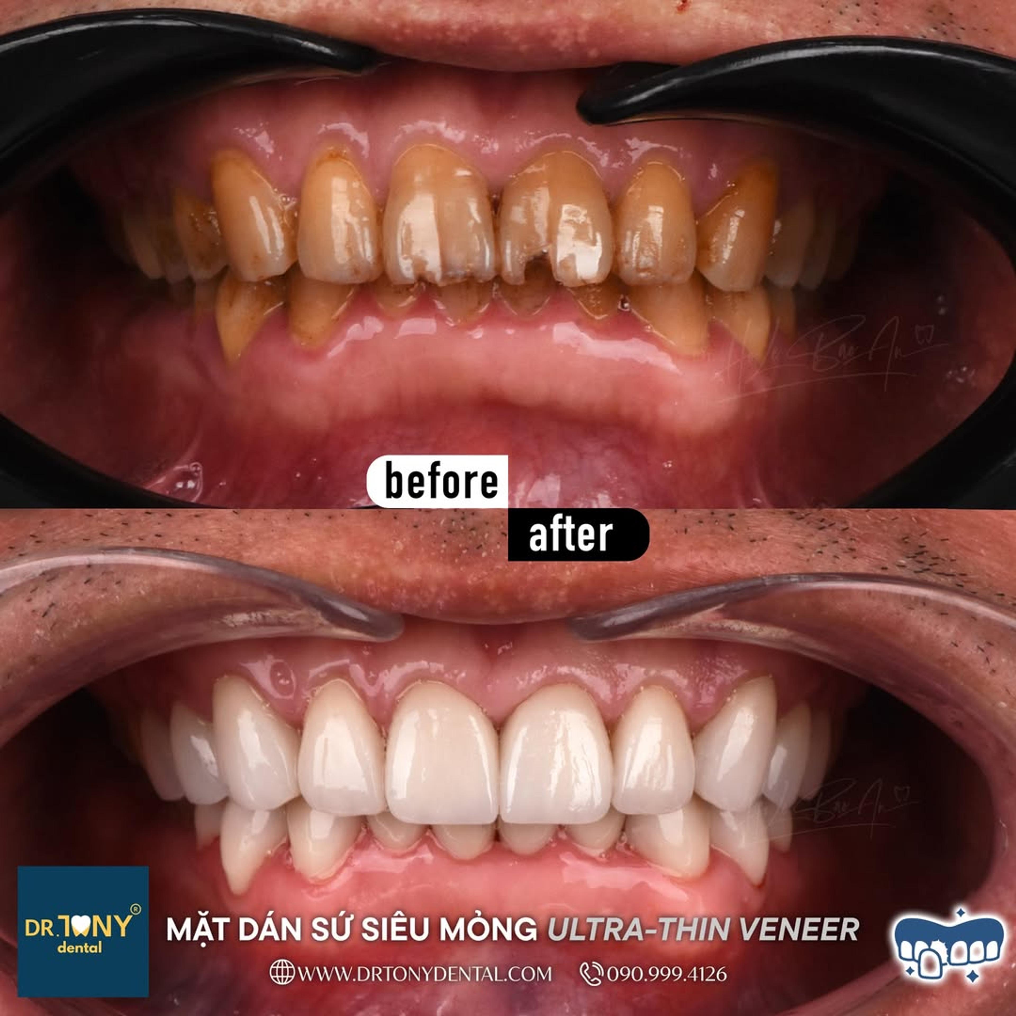 Intraoral views before and after ultra-thin veneers: heavily discoloured, worn teeth, even and bright afterwards