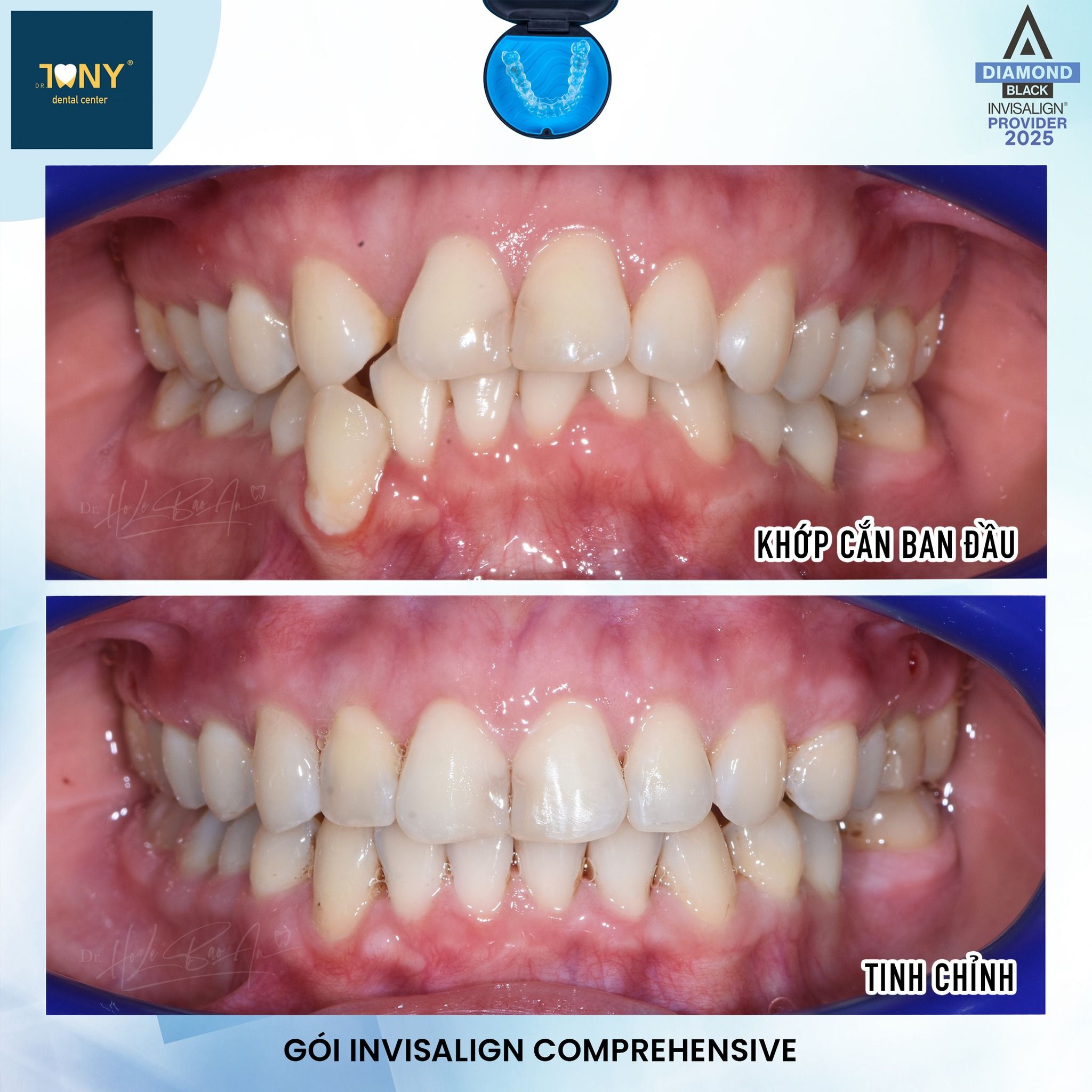 Ca Invisalign Comprehensive: khớp cắn ban đầu lệch và chen chúc, ảnh sau tinh chỉnh hai hàm đã khít