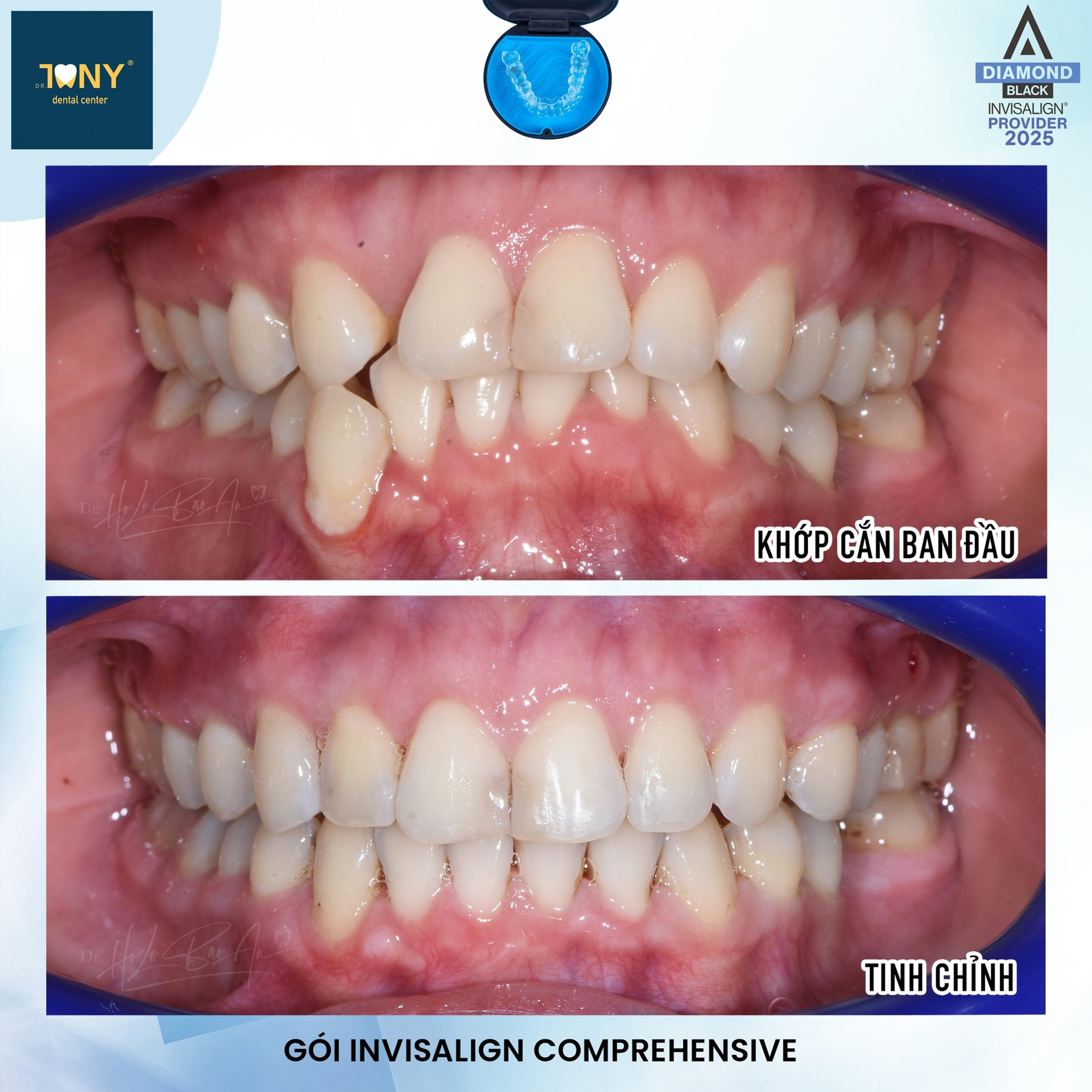 Ca Invisalign Comprehensive: khớp cắn ban đầu lệch và chen chúc, ảnh sau tinh chỉnh hai hàm đã khít