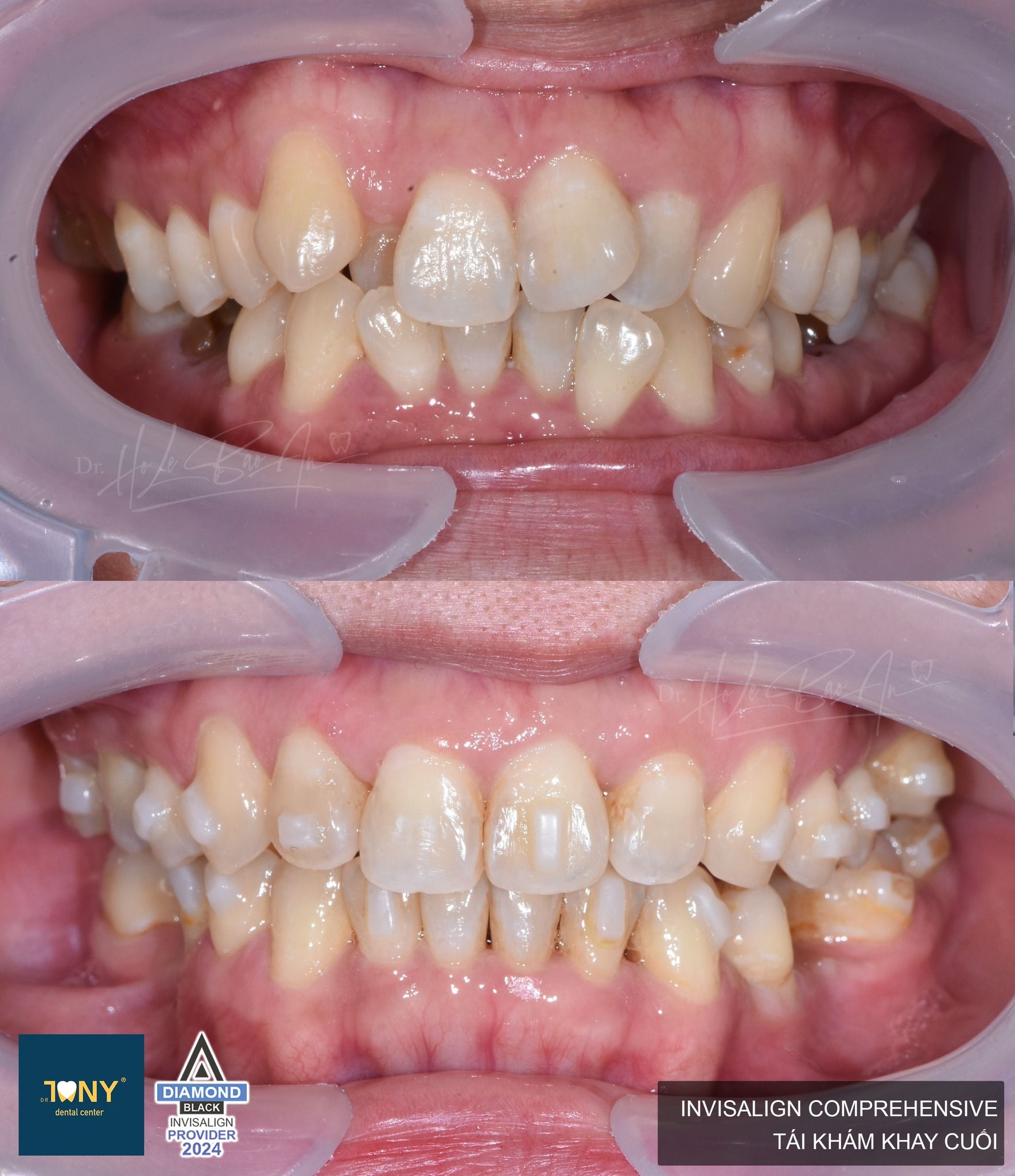 Ca Invisalign Comprehensive chen chúc nặng, răng nanh mọc chìa — ảnh ban đầu và ở lần tái khám khay cuối