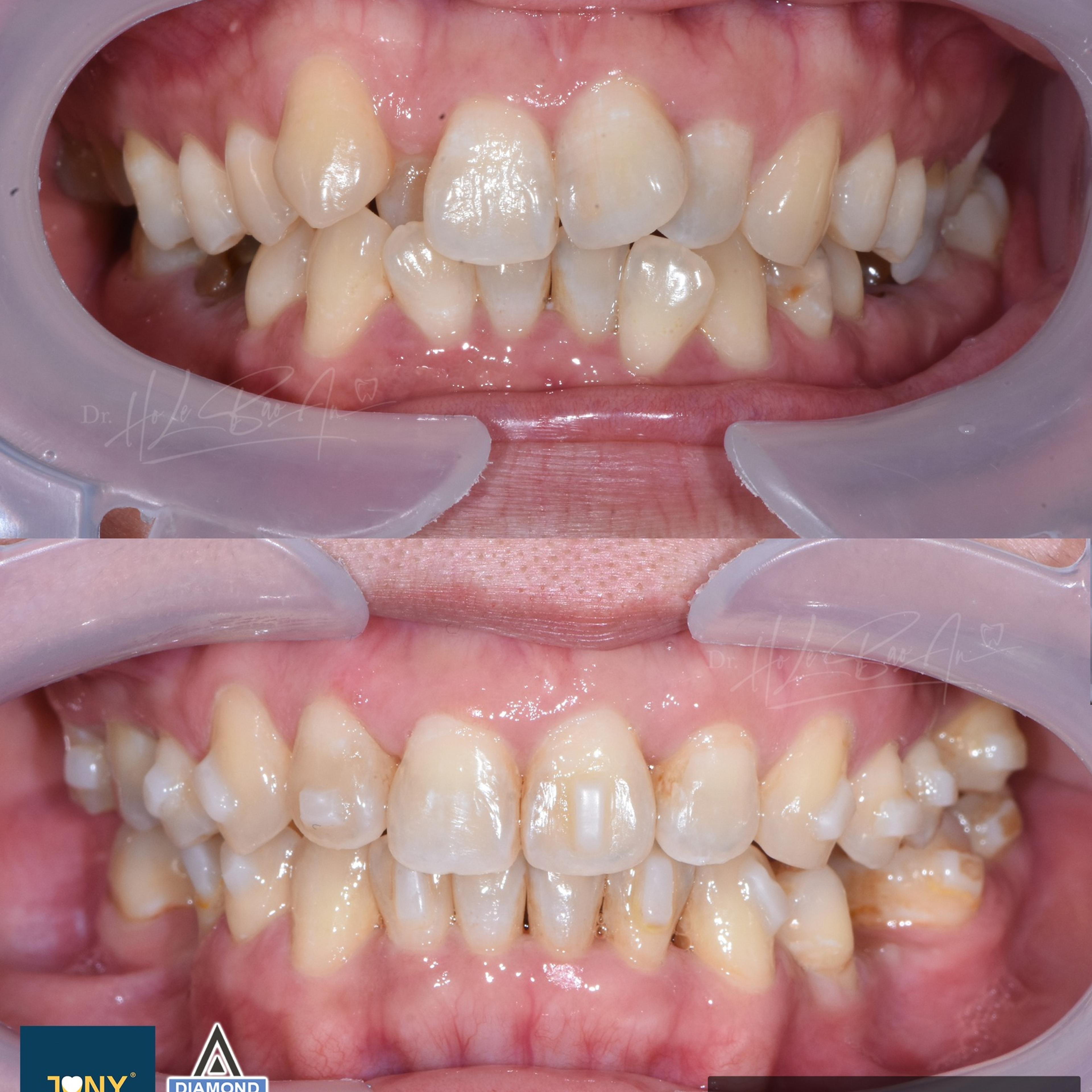 Ca Invisalign Comprehensive chen chúc nặng, răng nanh mọc chìa — ảnh ban đầu và ở lần tái khám khay cuối