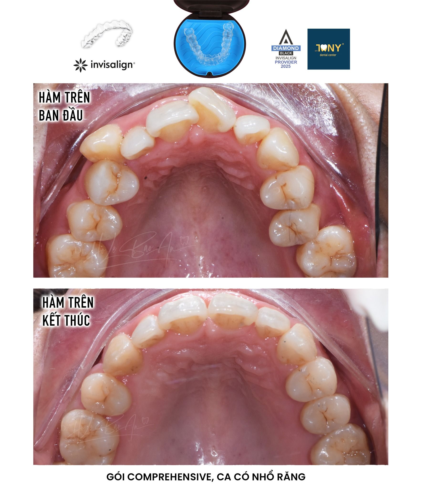 Ảnh mặt nhai hàm trên, ban đầu và khi kết thúc — ca Invisalign Comprehensive có nhổ răng, cung răng khép đều