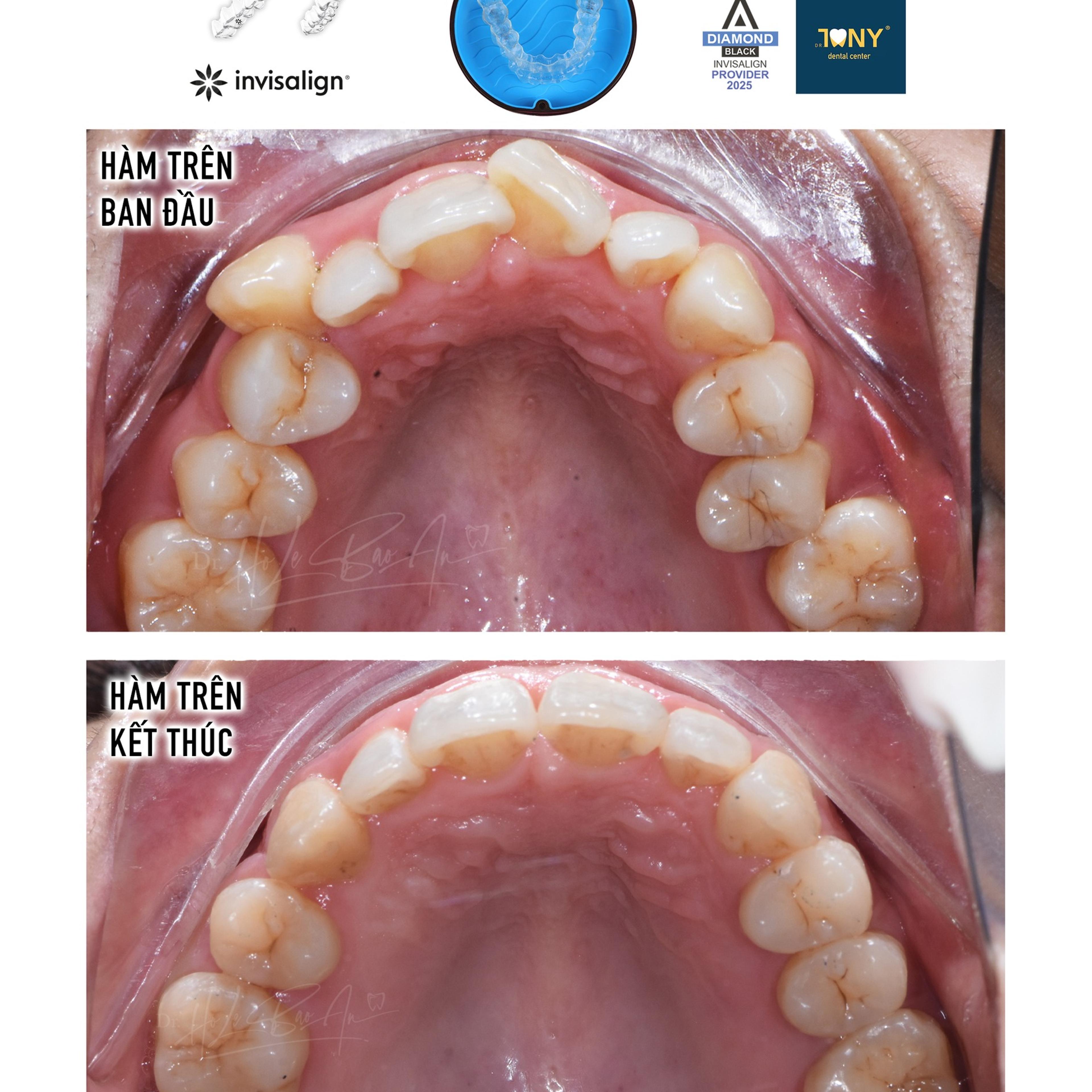Ảnh mặt nhai hàm trên, ban đầu và khi kết thúc — ca Invisalign Comprehensive có nhổ răng, cung răng khép đều