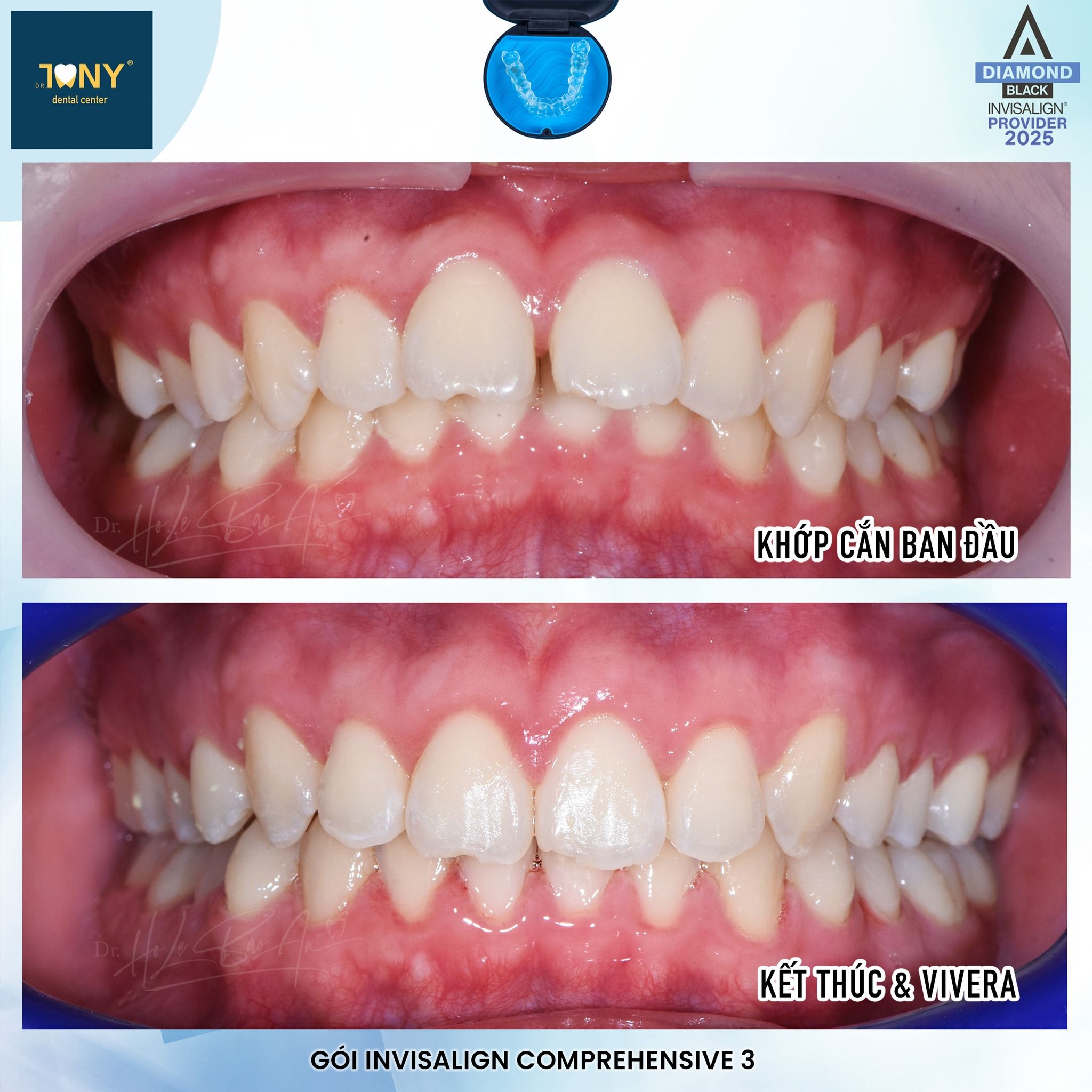 Ca Invisalign Comprehensive: khớp cắn ban đầu và khi kết thúc, chuyển sang hàm duy trì Vivera