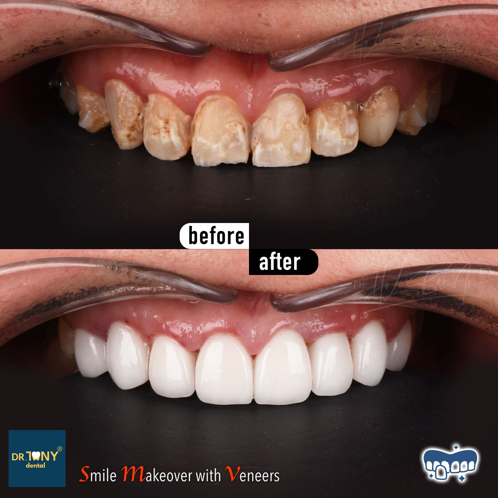 Close-up of the upper arch before and after veneers: short, worn and discoloured crowns, evened out afterwards
