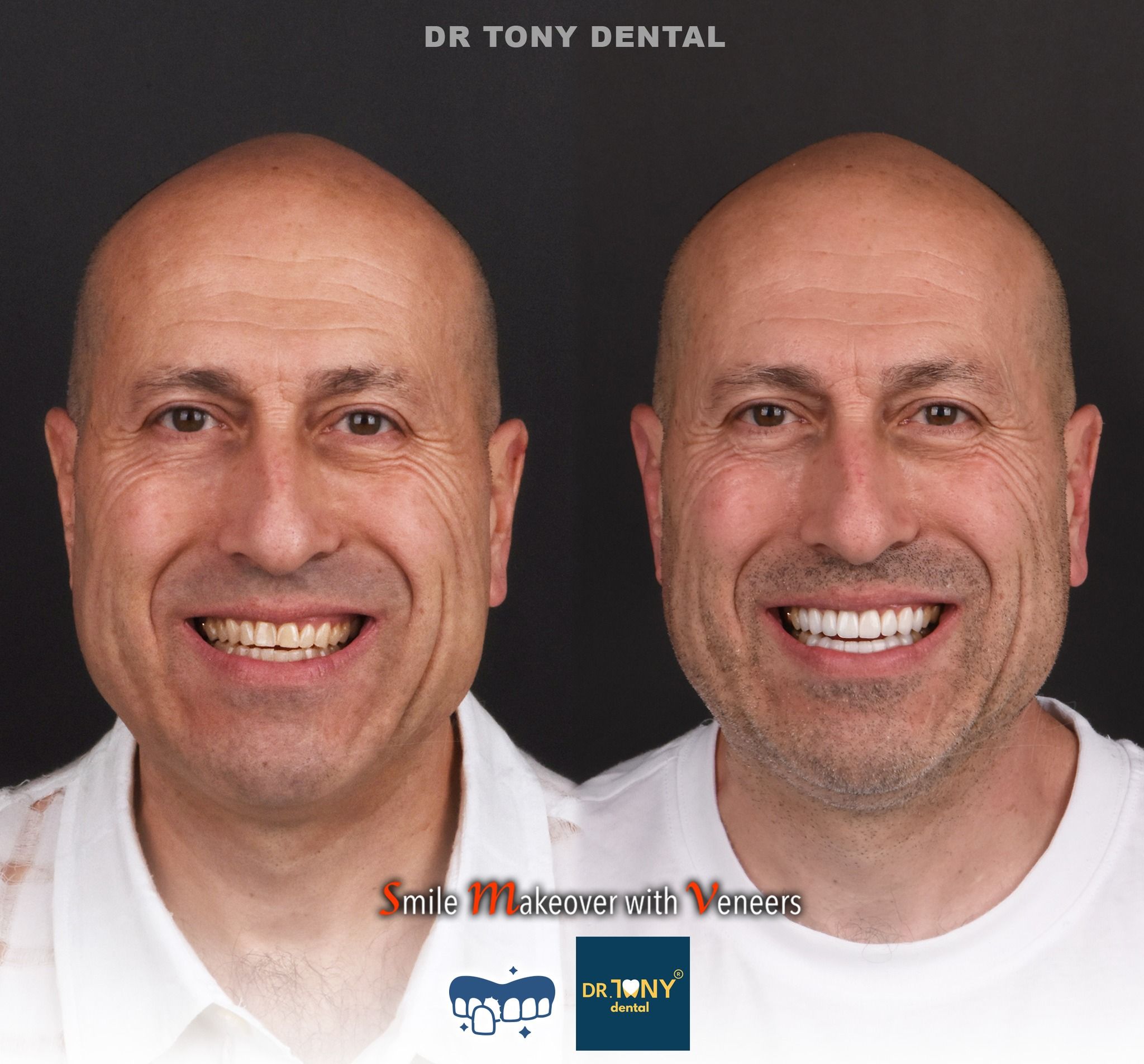 Full-face smile before and after porcelain veneers: yellowed, uneven teeth, even in colour and shape afterwards