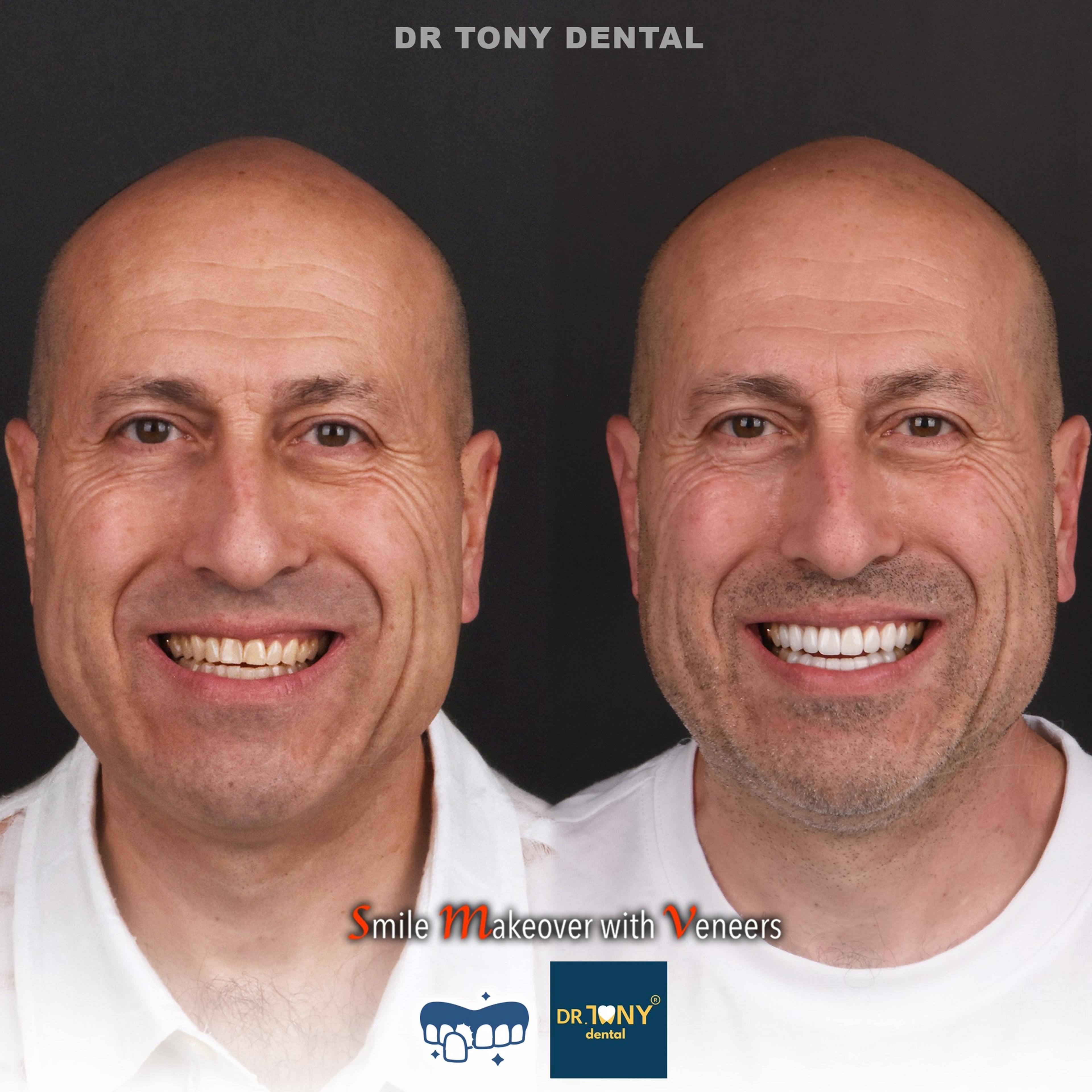 Full-face smile before and after porcelain veneers: yellowed, uneven teeth, even in colour and shape afterwards