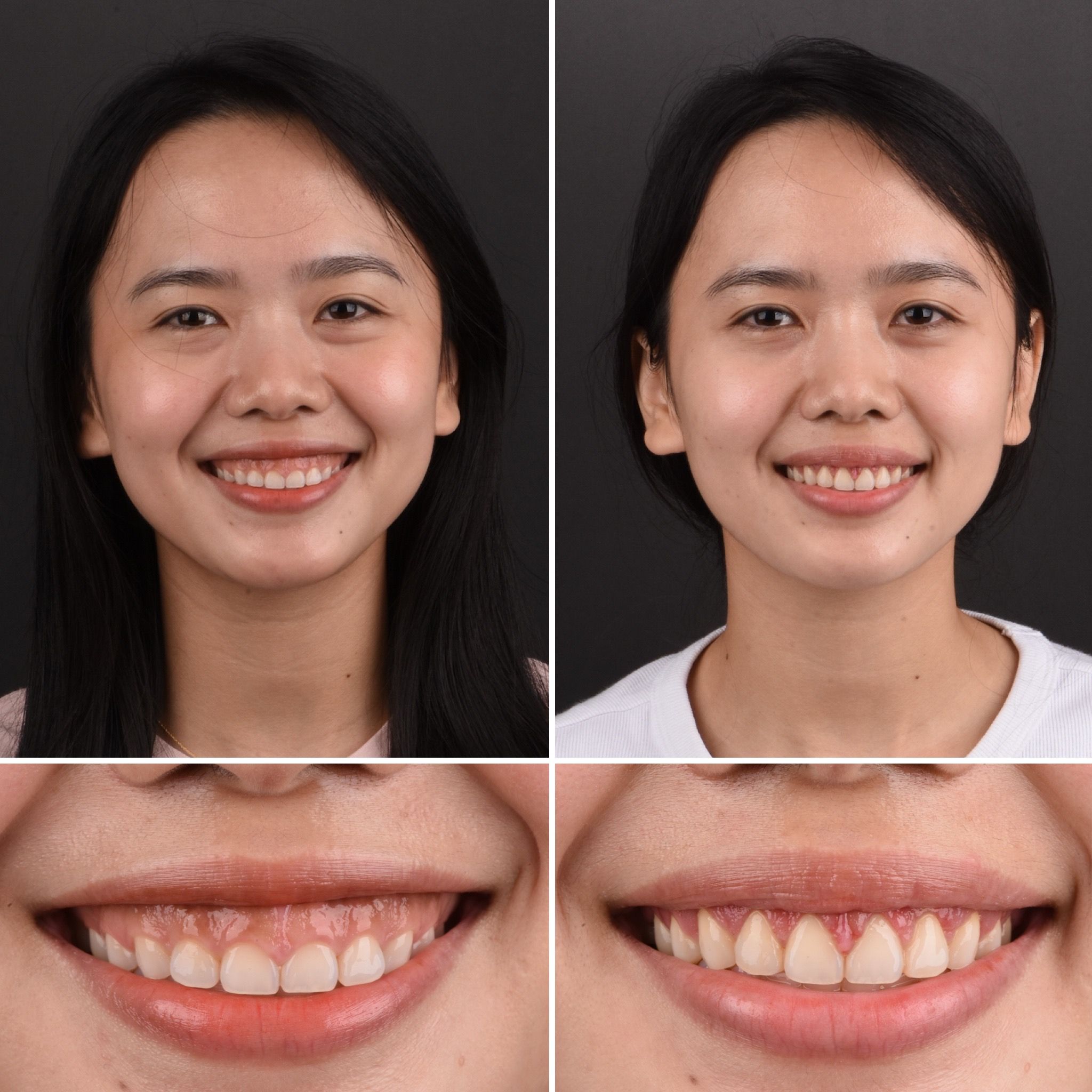 Chân dung và cận cảnh nụ cười, trước và sau điều trị thẩm mỹ răng tại Dr Tony Dental
