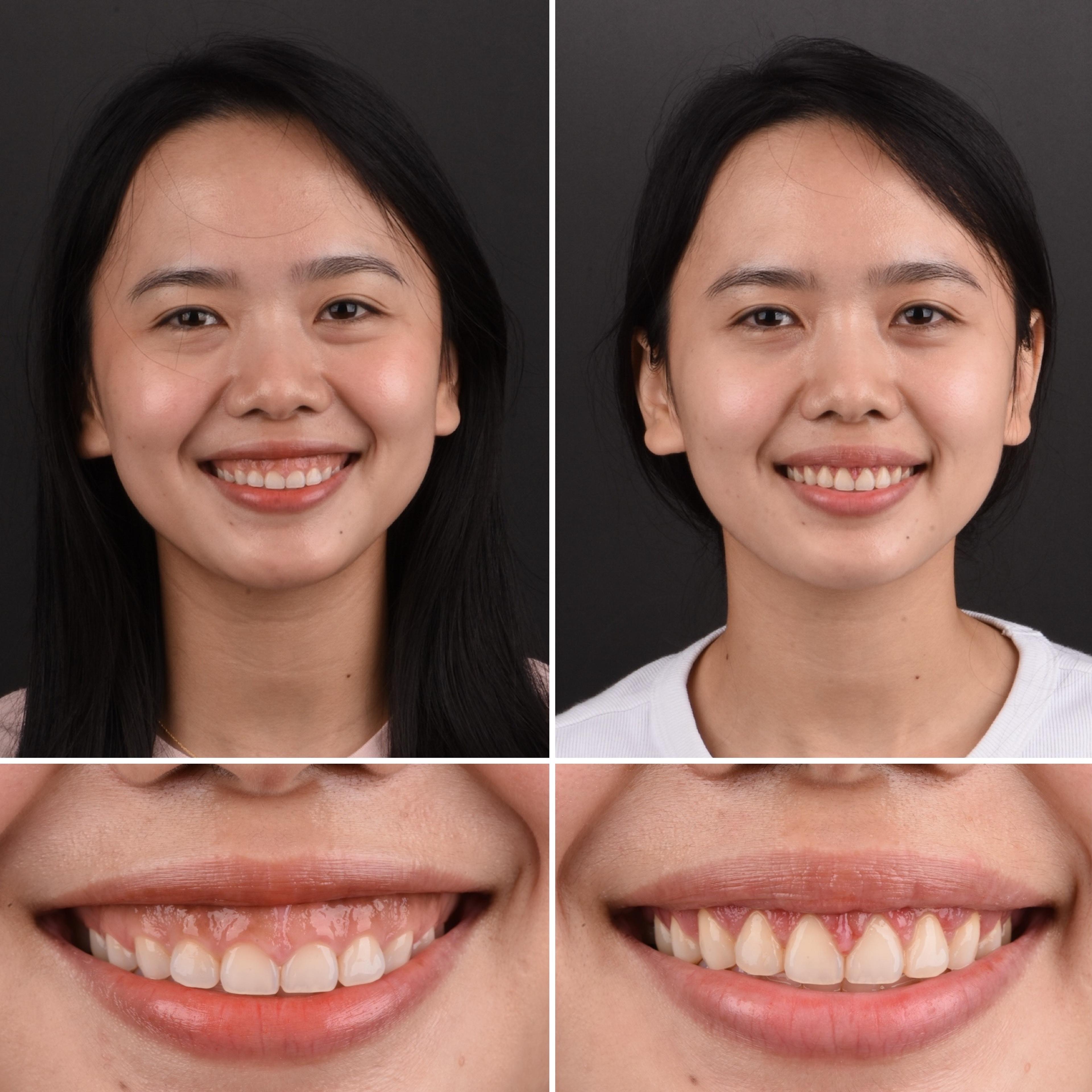 Chân dung và cận cảnh nụ cười, trước và sau điều trị thẩm mỹ răng tại Dr Tony Dental