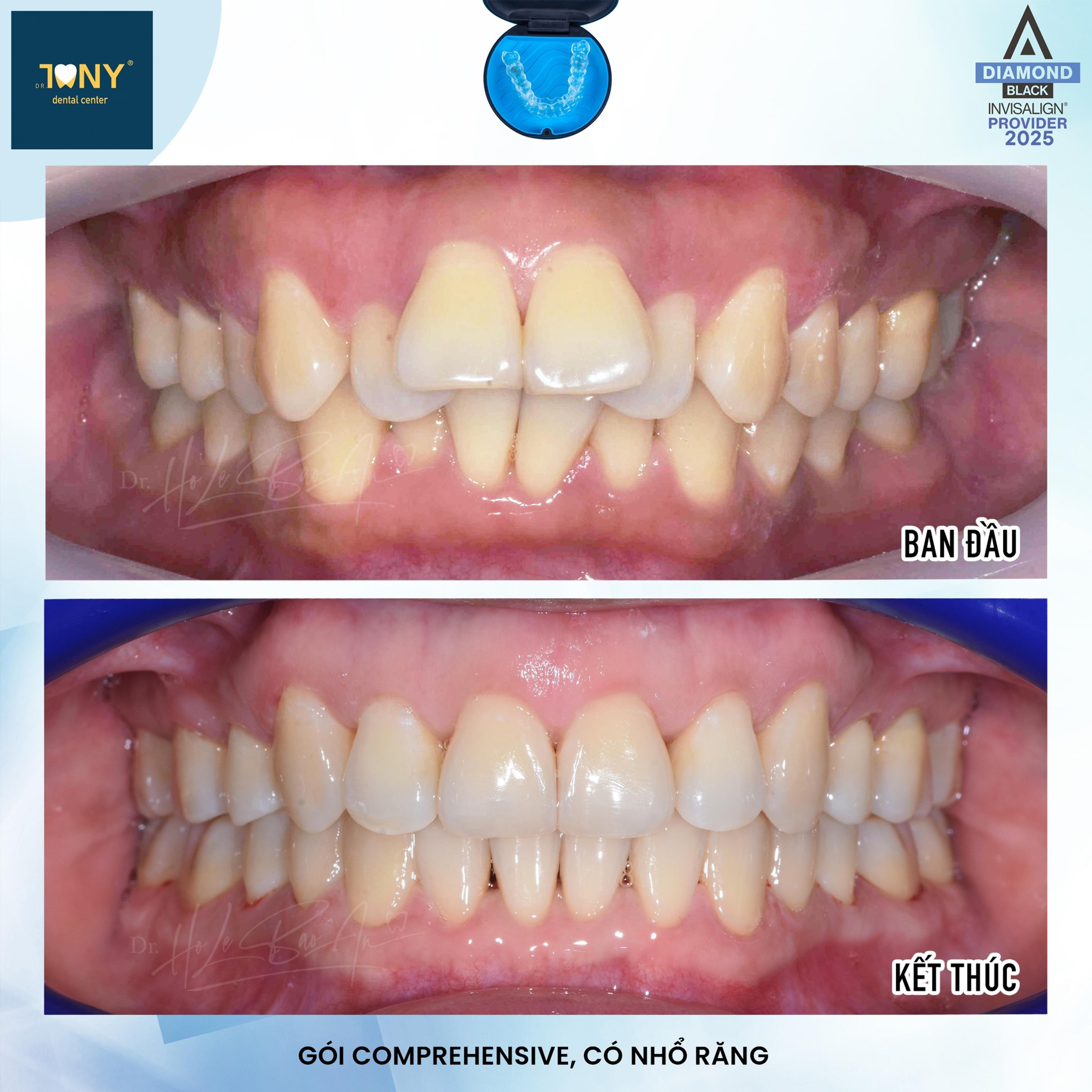 Ca Invisalign Comprehensive có nhổ răng: ảnh trong miệng ban đầu răng chìa và chen chúc, và ảnh khi kết thúc