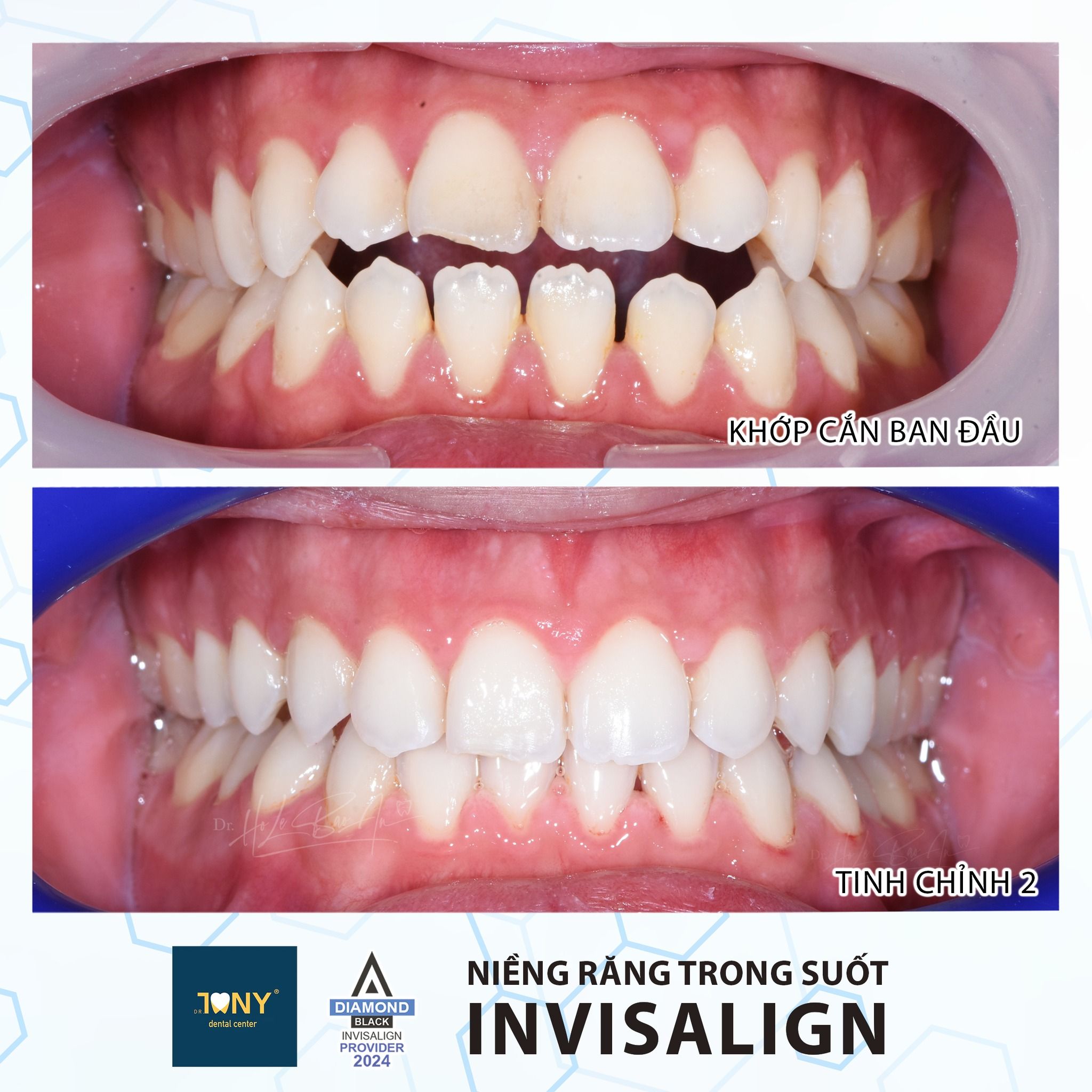 Ca cắn hở vùng răng cửa: khớp cắn ban đầu hai hàm không chạm nhau, và ảnh sau tinh chỉnh lần 2 bằng khay Invisalign