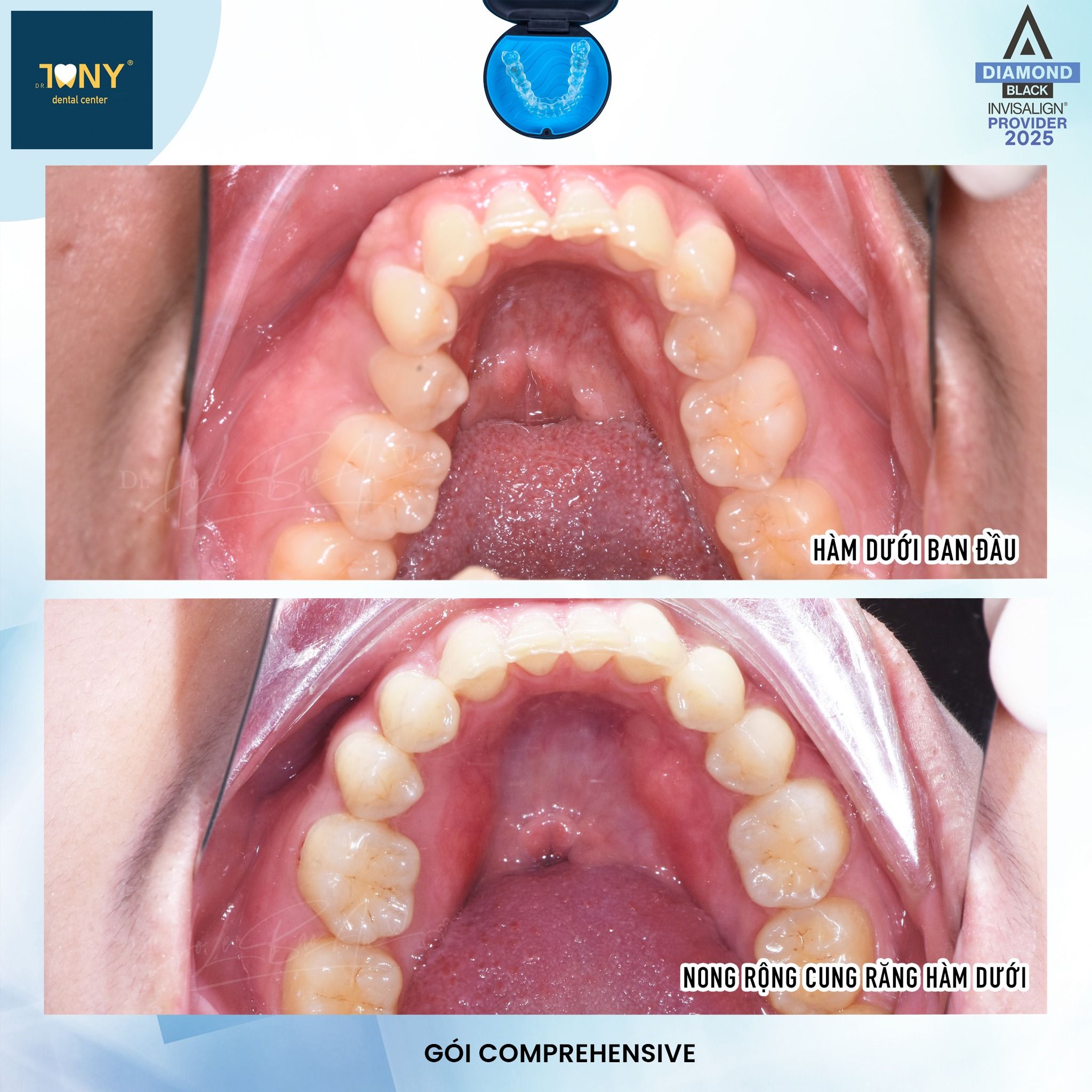 Ảnh mặt nhai hàm dưới trước và sau khi nong rộng cung răng bằng khay Invisalign, gói Comprehensive