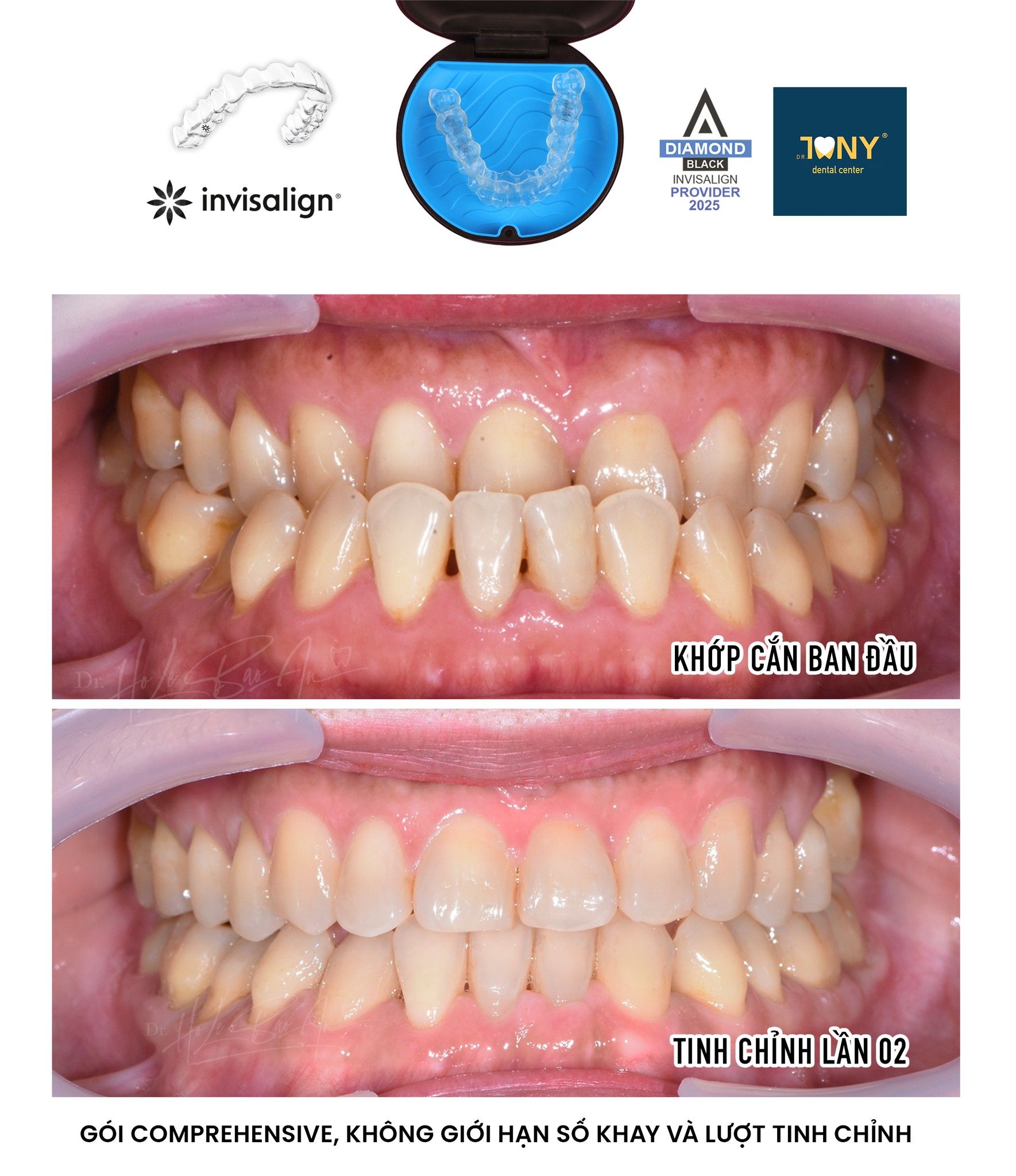 Chân dung trước và sau niềng Invisalign: răng cửa hàm trên chen chúc, sau điều trị nụ cười đều và rộng hơn