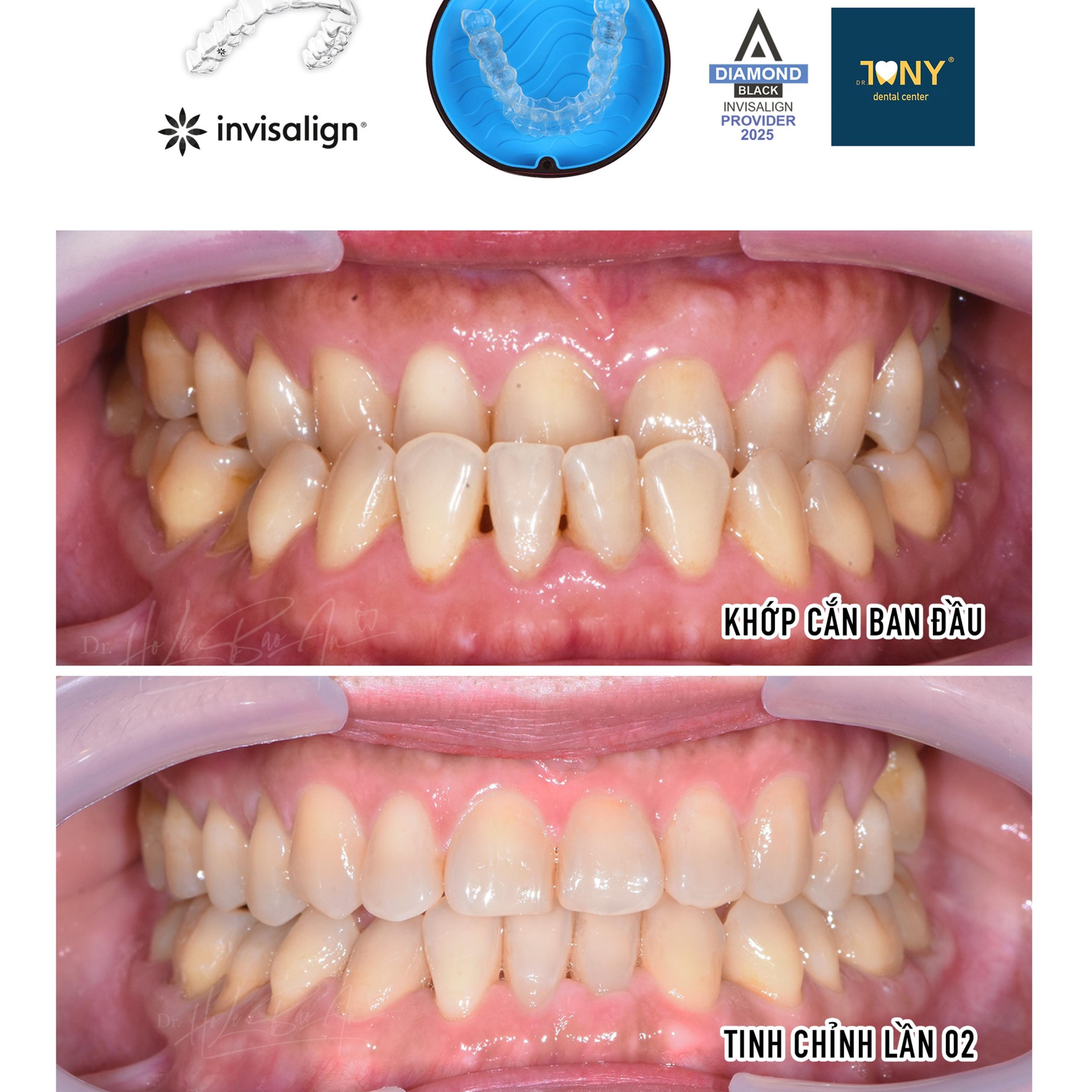 Chân dung trước và sau niềng Invisalign: răng cửa hàm trên chen chúc, sau điều trị nụ cười đều và rộng hơn
