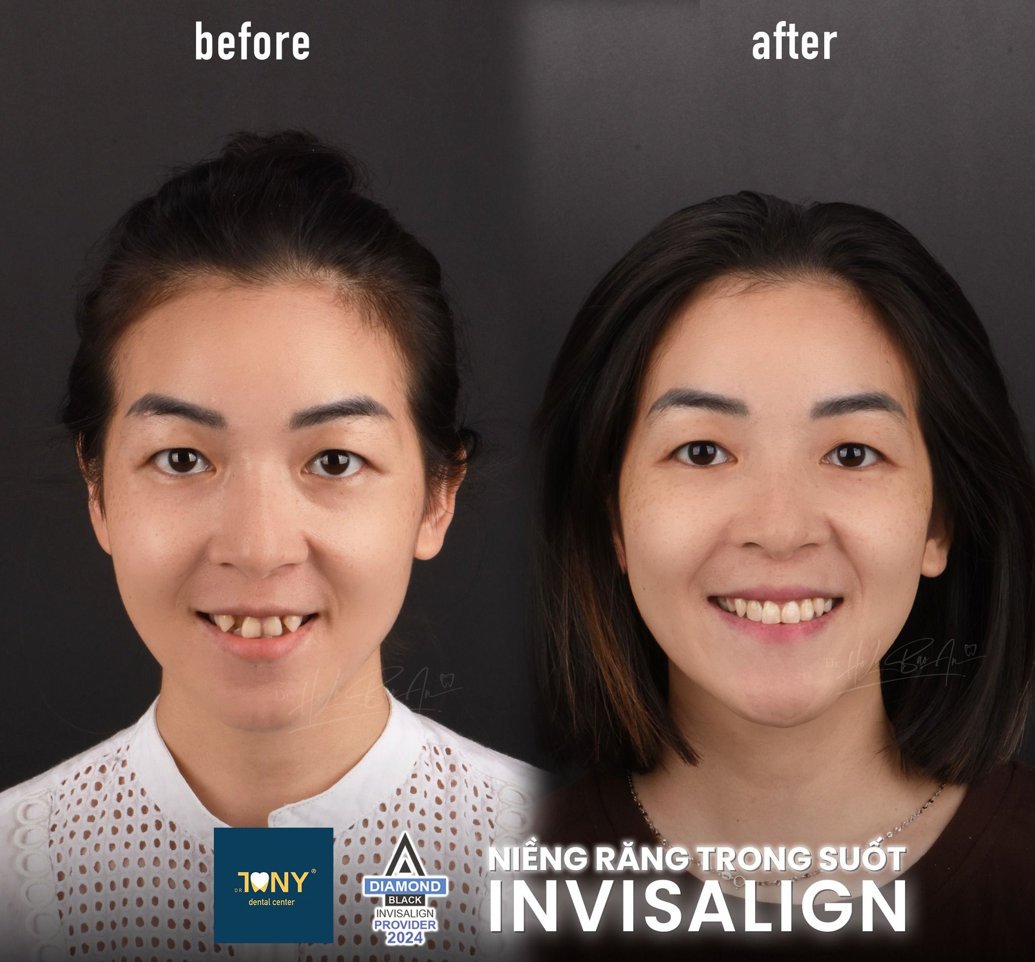 Chân dung trước và sau niềng Invisalign: răng cửa chen chúc và chìa ra trước, sau điều trị cung răng đều