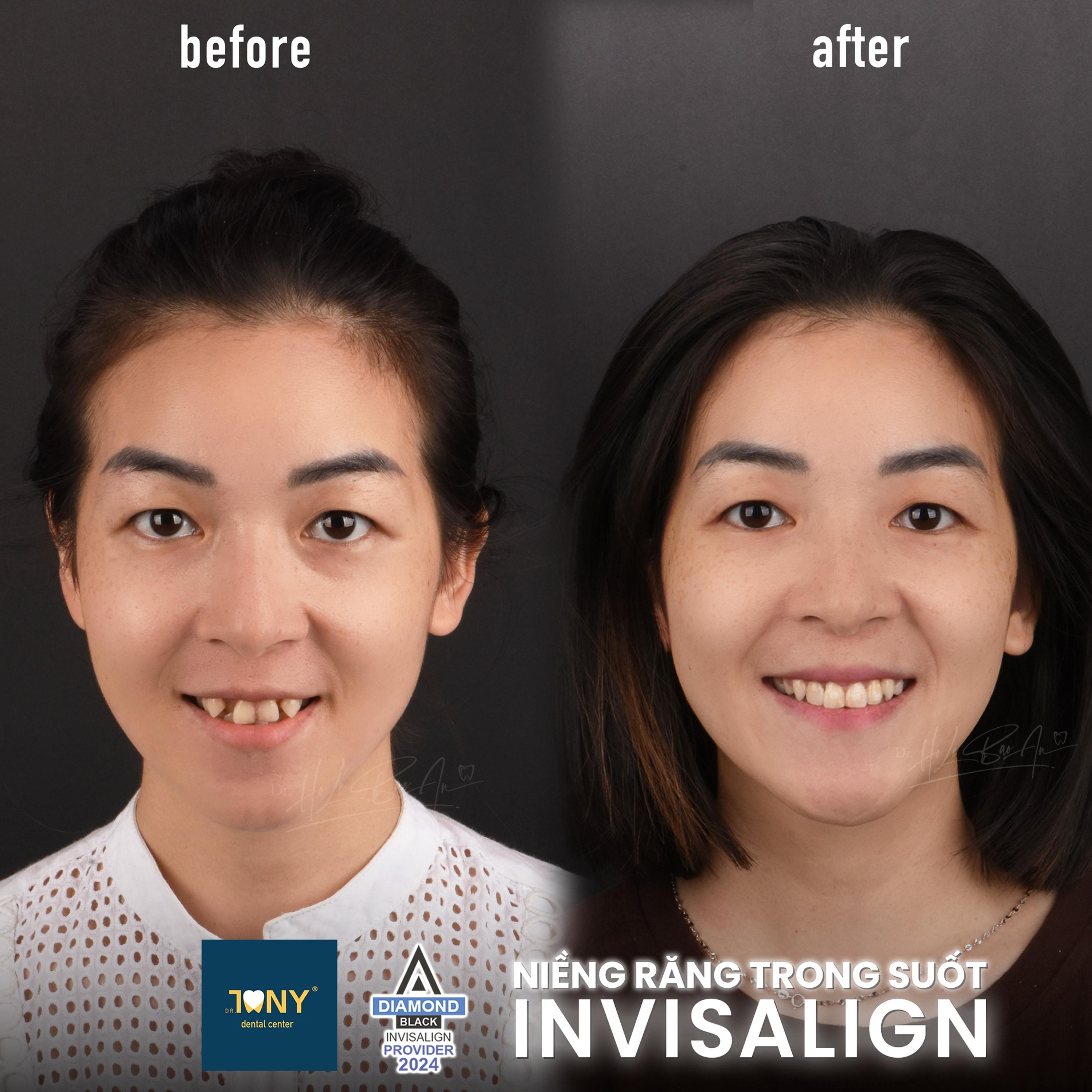 Chân dung trước và sau niềng Invisalign: răng cửa chen chúc và chìa ra trước, sau điều trị cung răng đều