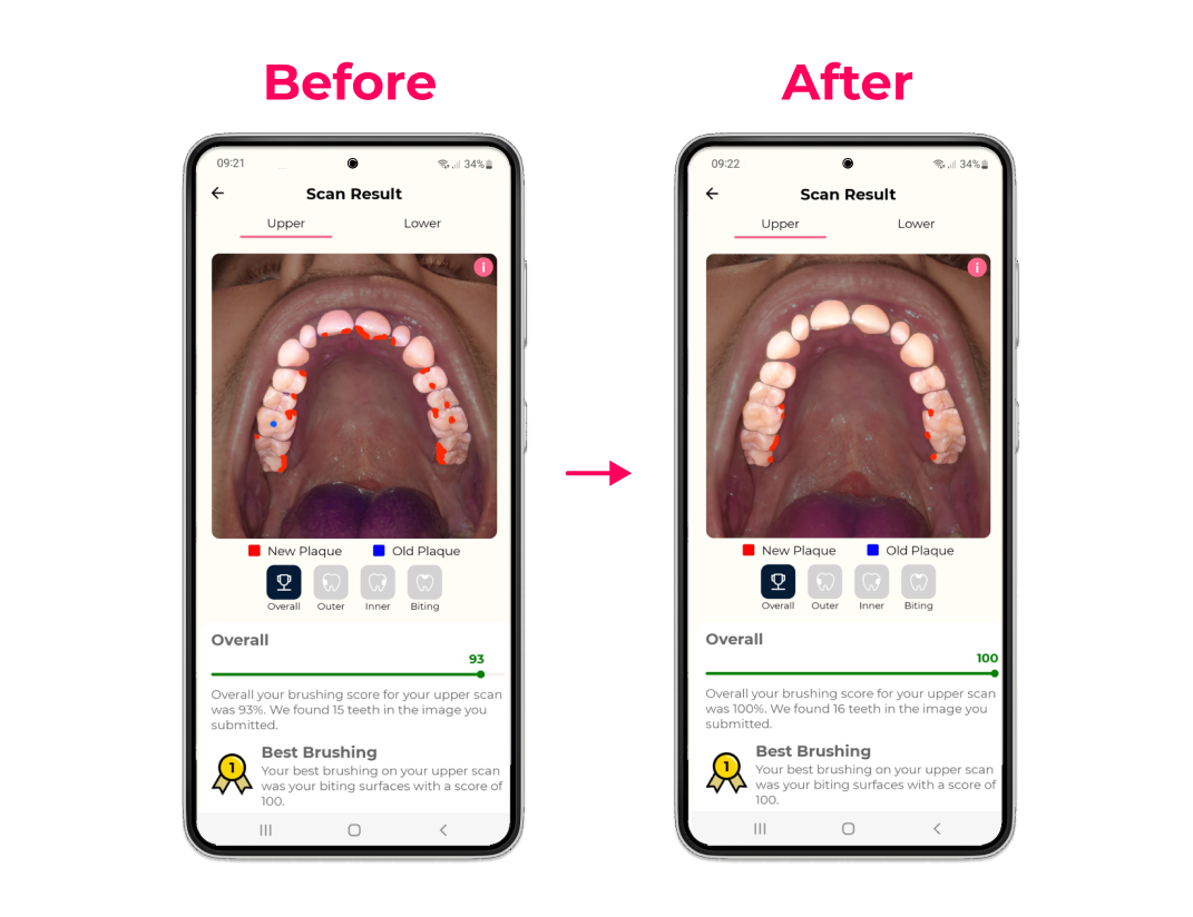 Image showing plaque accumulation before and after using the SURI electric toothbrush