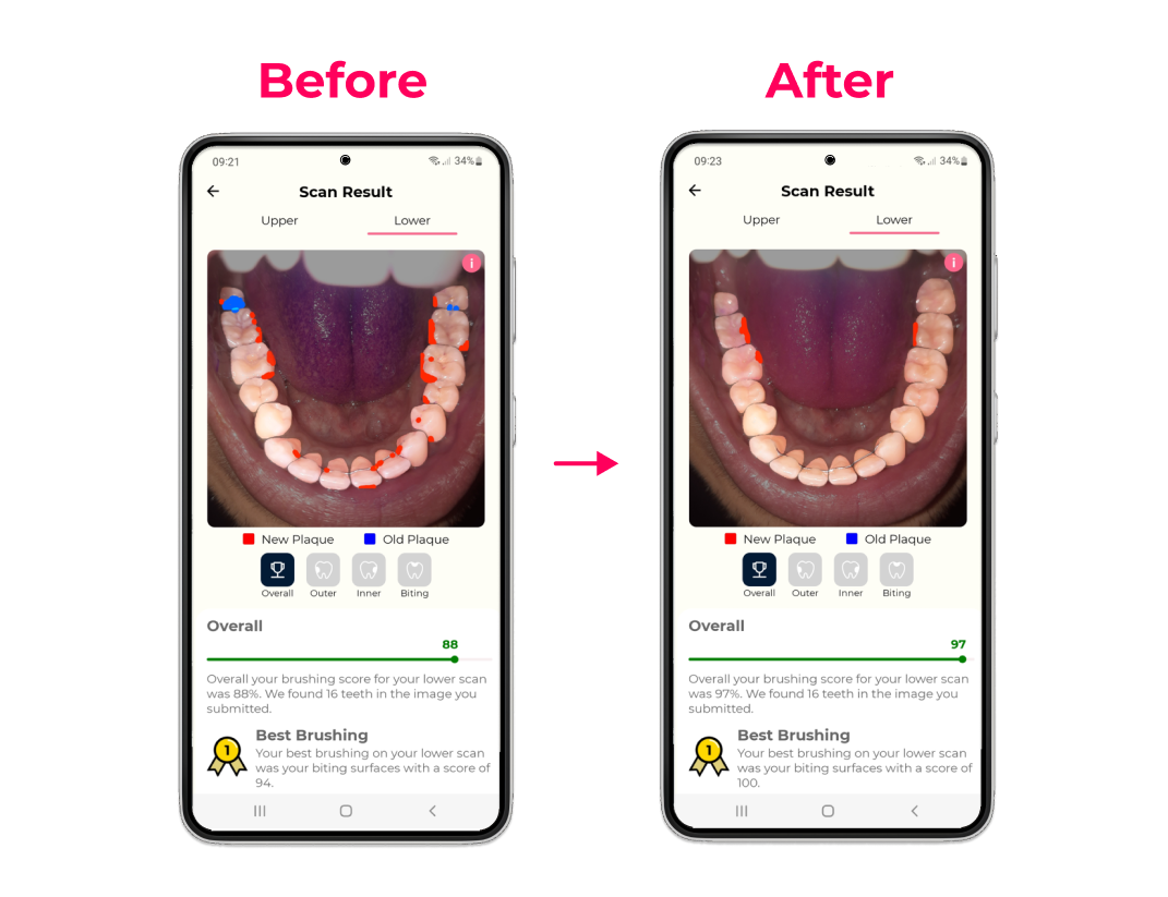 Screenshot from the Testmyteeth mobile app showing plaque on lower teeth before and after using the SURI electric toothbrush