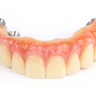 An example of an implant-retained denture that pairs dental dentures with implantology.