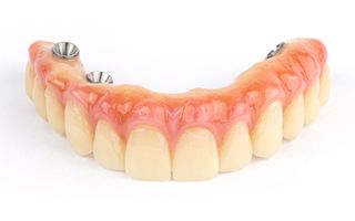 Image of a implant retained dentures.